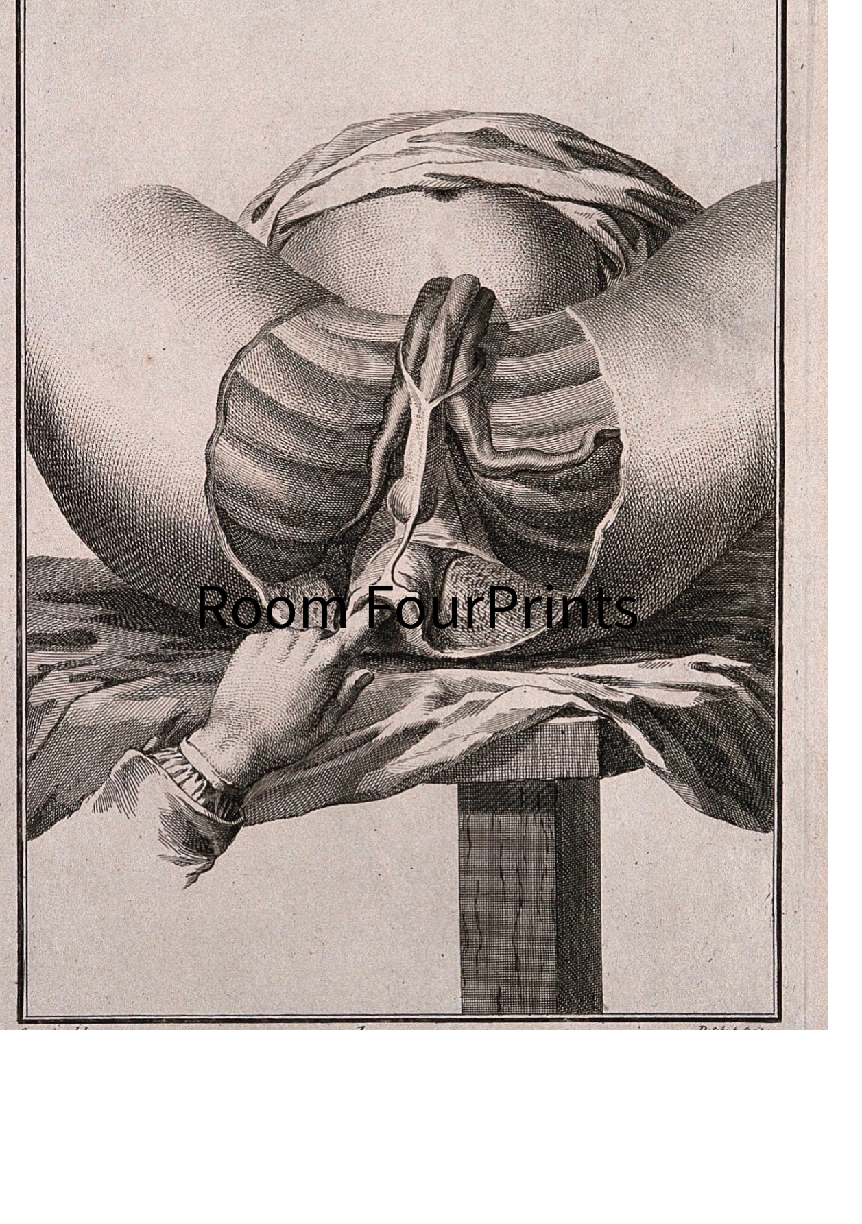 Medical Art Print / Perineum Engraving by Foubert / Chirurgi