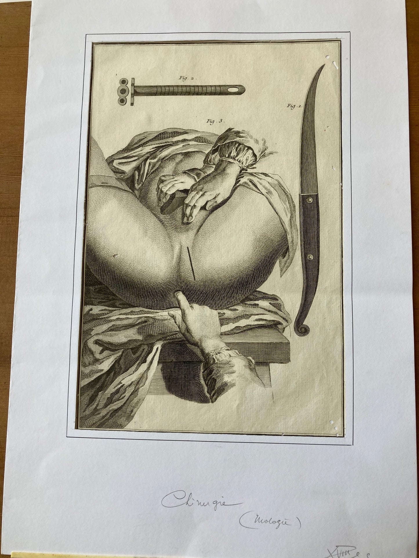 Early Surgical Engraving - French - Room Four