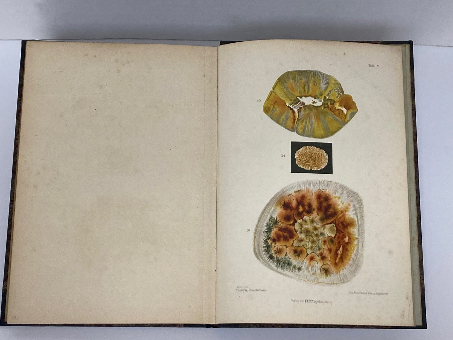 Klinik der Cholelithiasis, First Edition, 1892,(Gall Stones) - Room Four