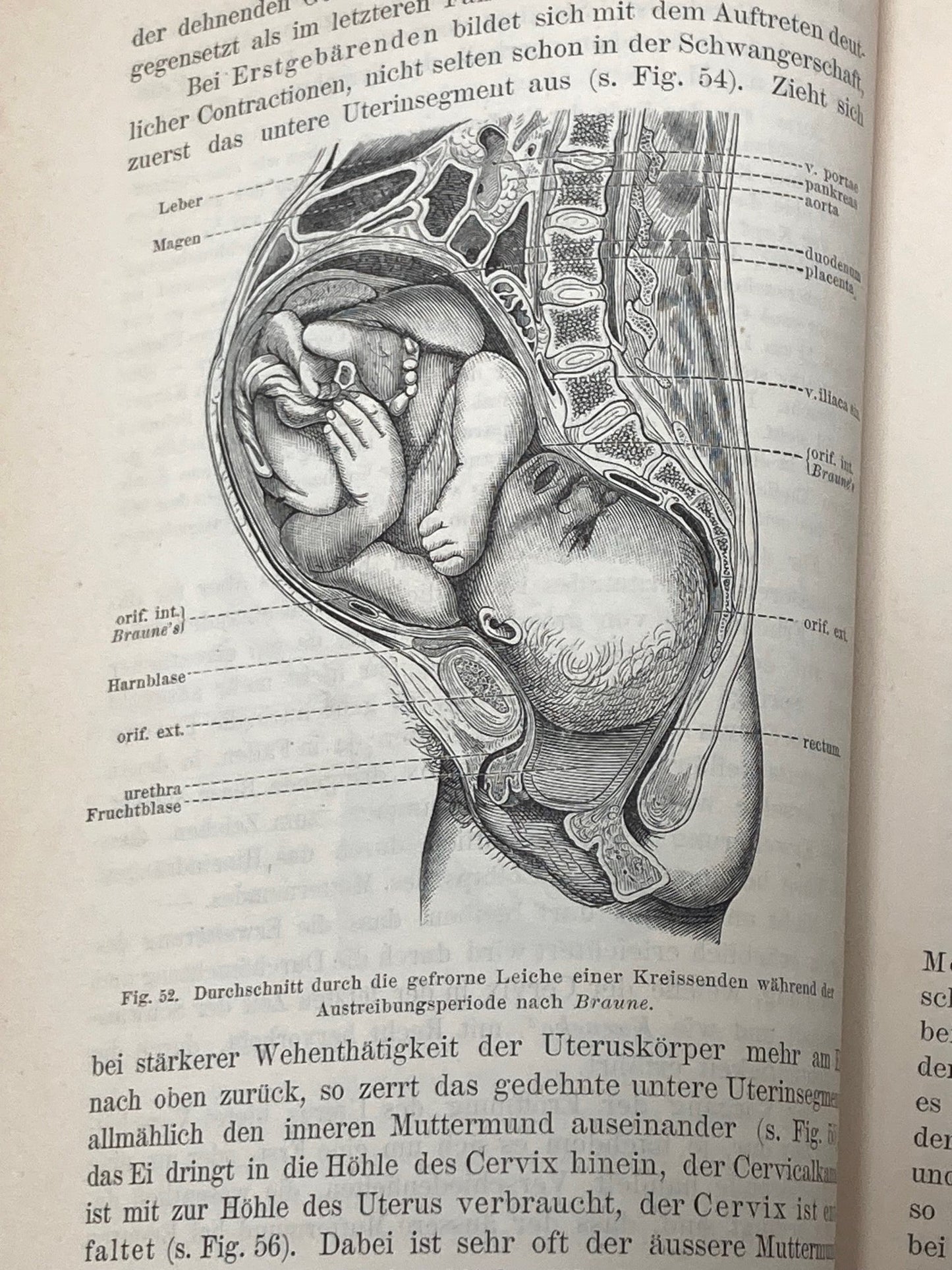 (Obstetrics) Lehrbuch der Geburtshilfe - 1891 - Room Four