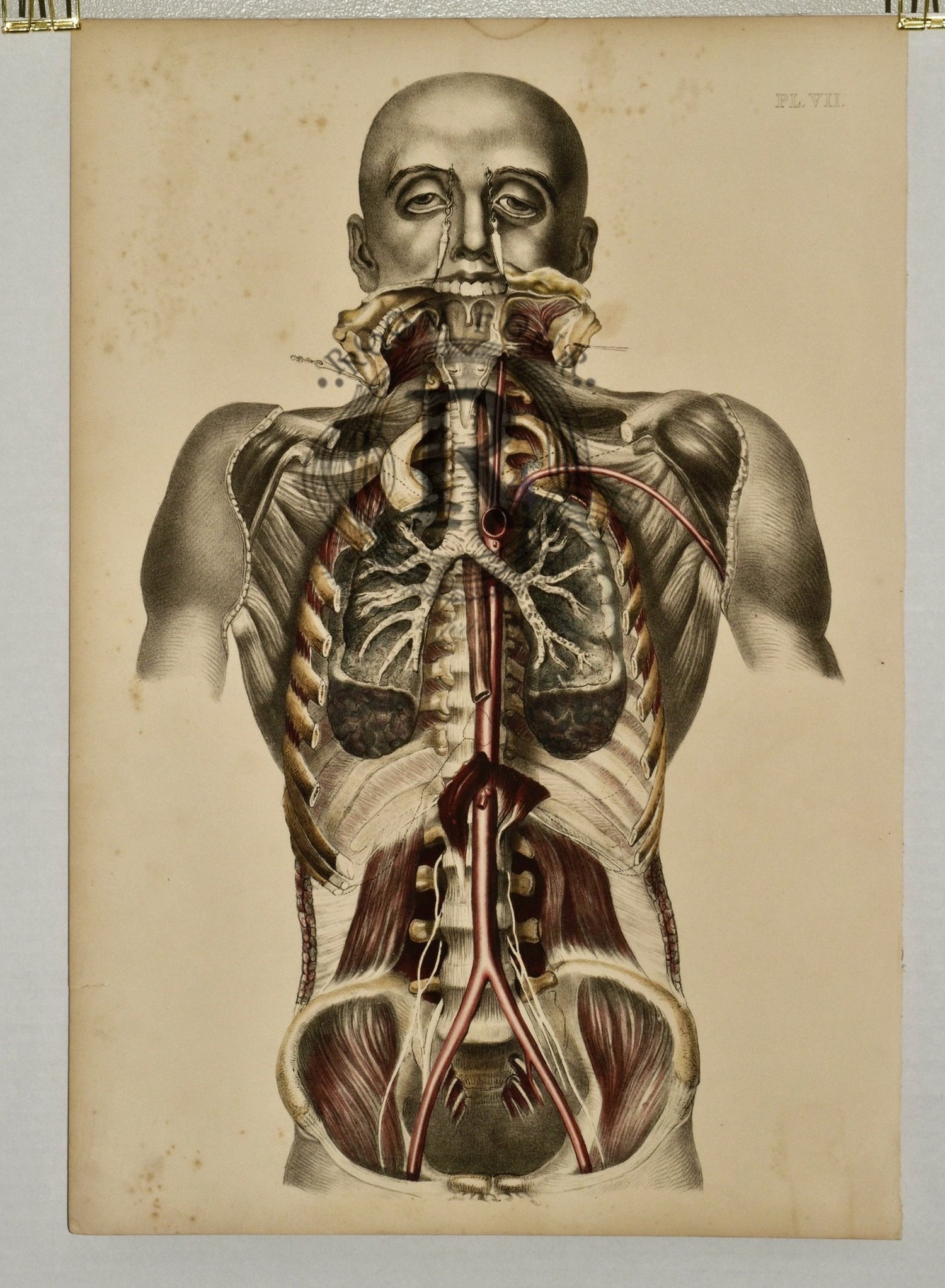 Sibson 19th Century Anatomical Post Mortem Surgical Dissections - Room Four