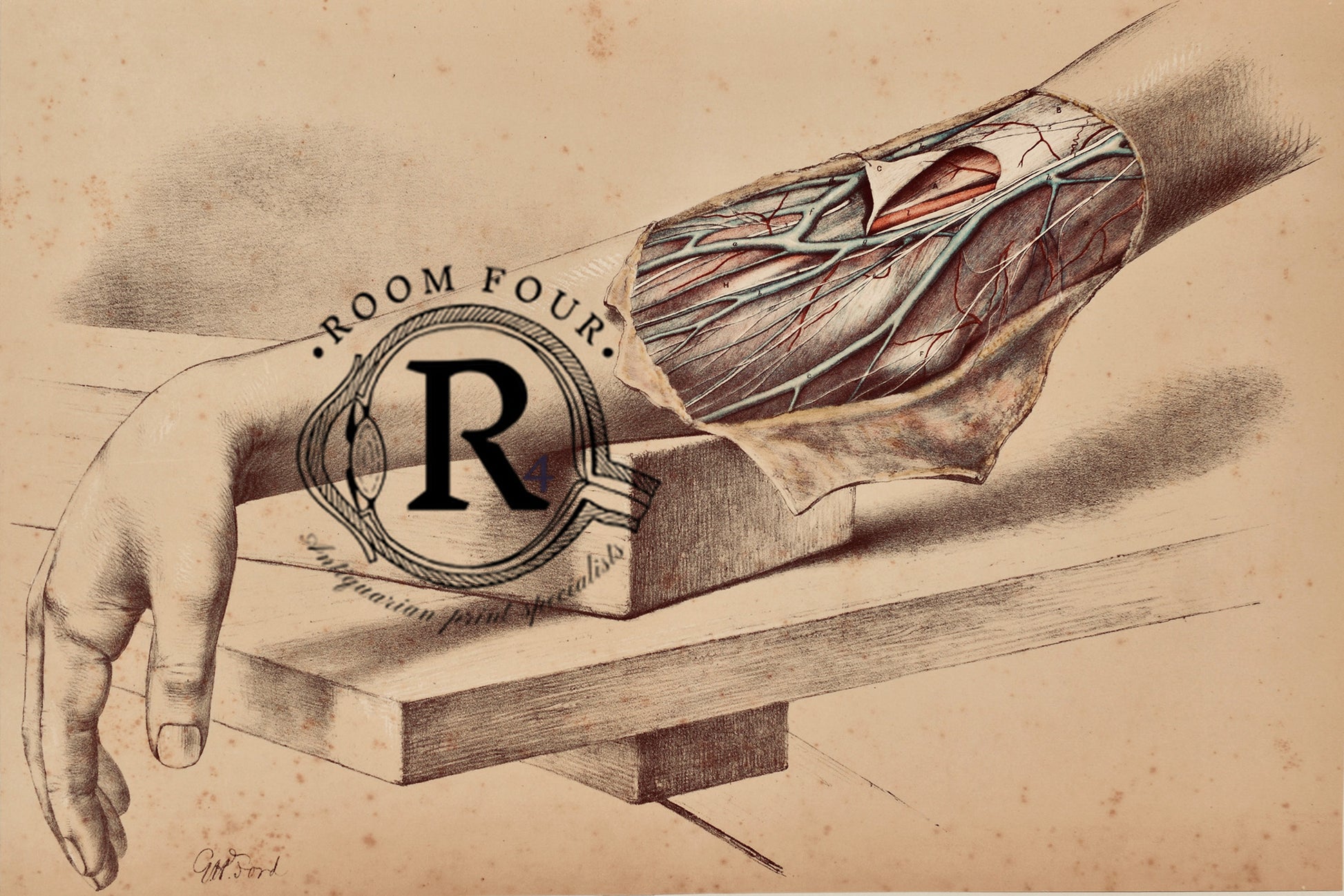 A Rare 1865 medical illustration of right arm flap, drawn life-size by George Henry Ford — antique anatomical print.Veins