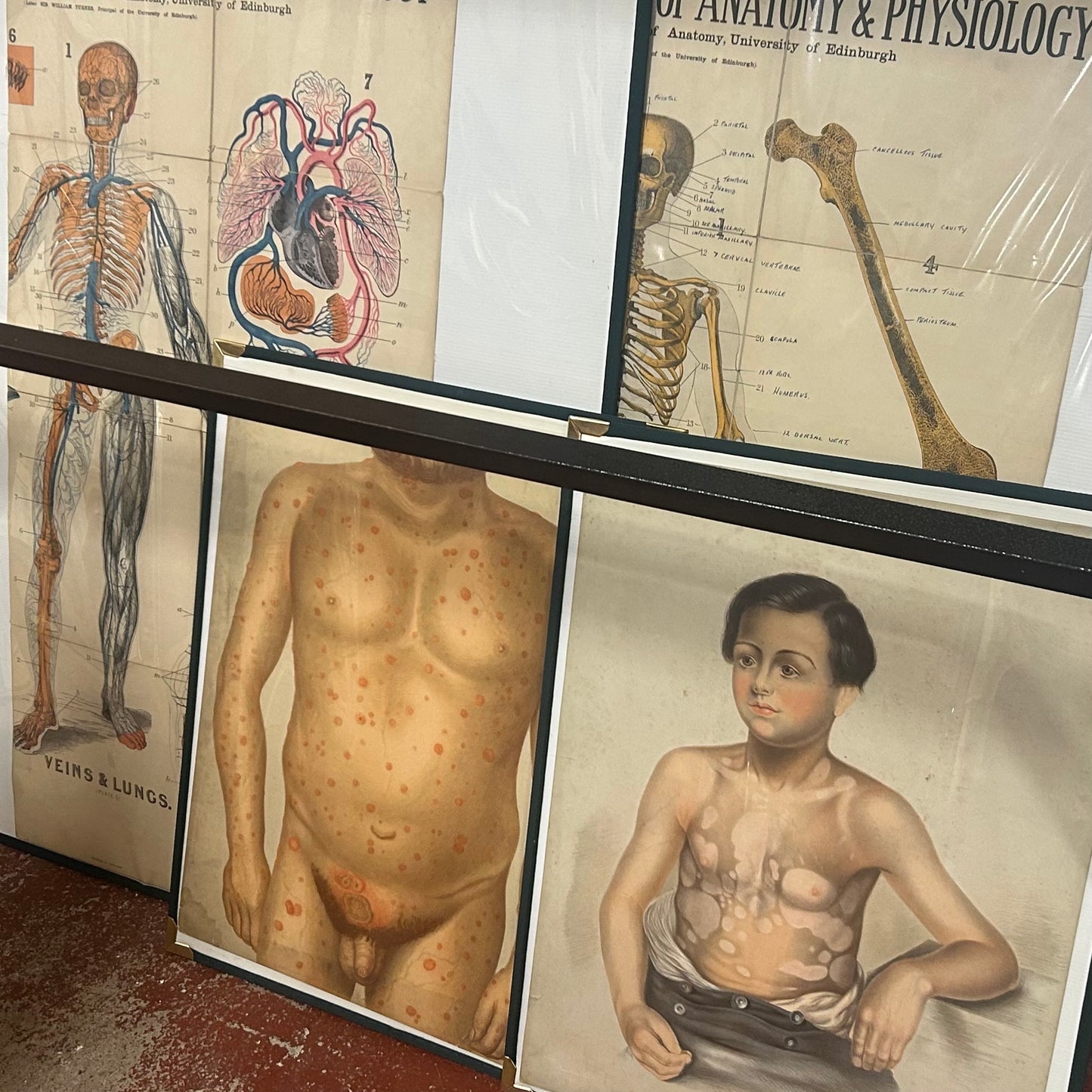 Victorian Medical Illustrated Print – 19th‑Century Dermatology Skin Disease Plate
