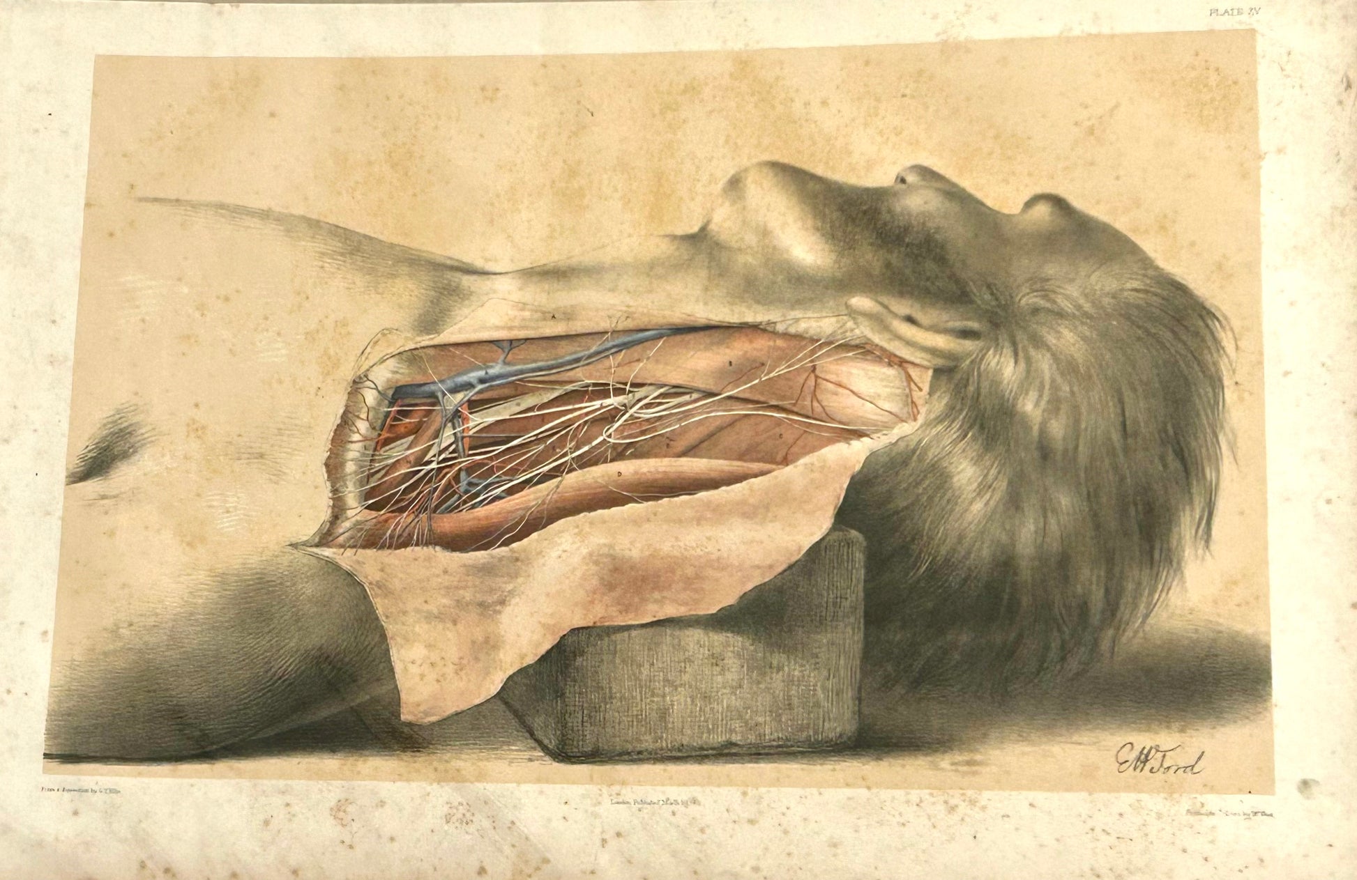 The anatomy of the side of the neck behind the sterno-
MASTOID MUSCLE / Lateral muscles of the neck/Posterior triangular space — its boundaries and contents/Arteries in the space, and ligature of the third part of the subclavian/External jugular vein and blood-letting/Nerves in the triangular space”