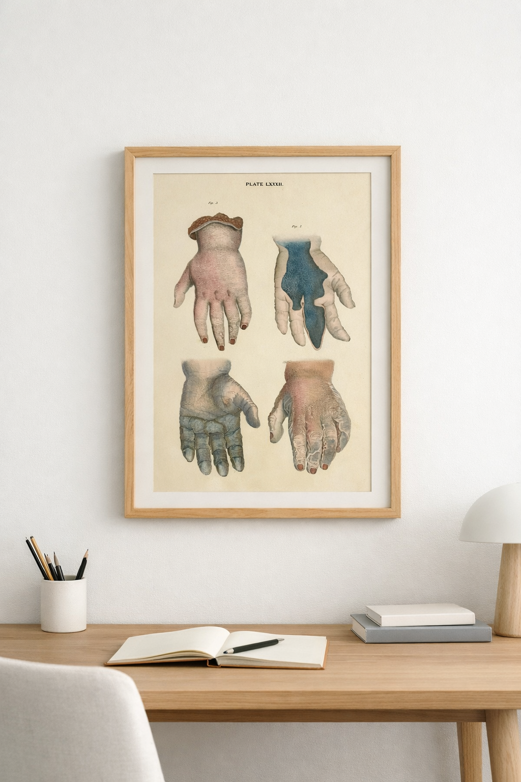 W. H. Lizars — Pathalogical Conditons/ Hand — Copperplate Engraving — Anatomical Print — 19th Century