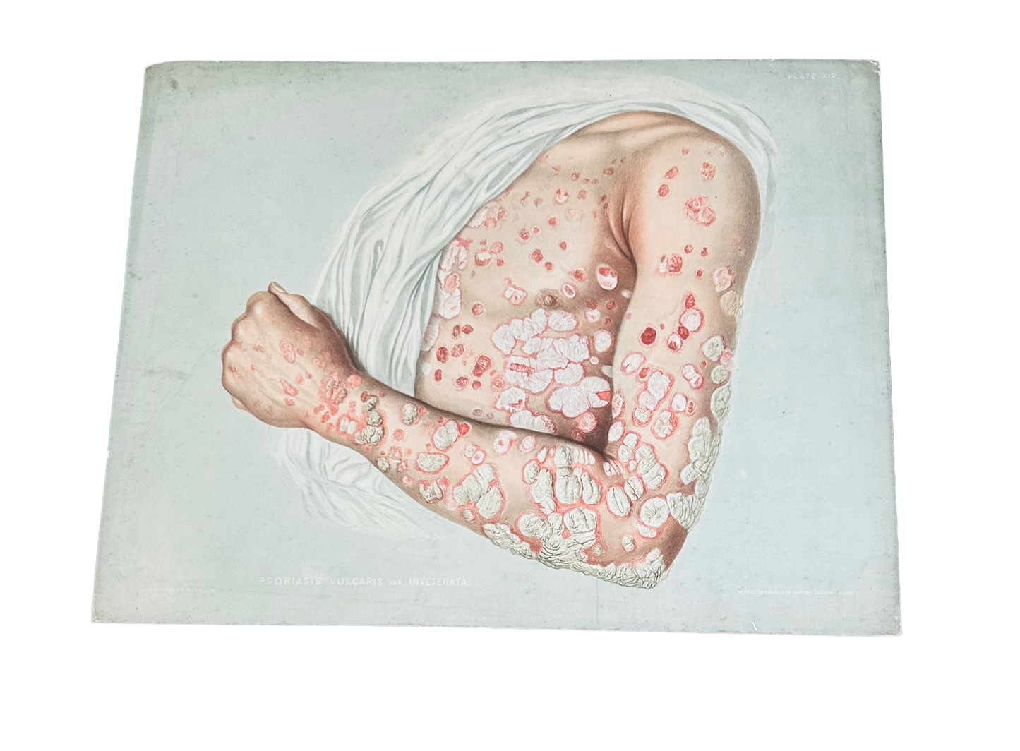 Victorian Medical Chromolithograph –  E. Burgess Diseases of the Skin  - Psoriasis Vulcaris (c.1870s) Plate XIV