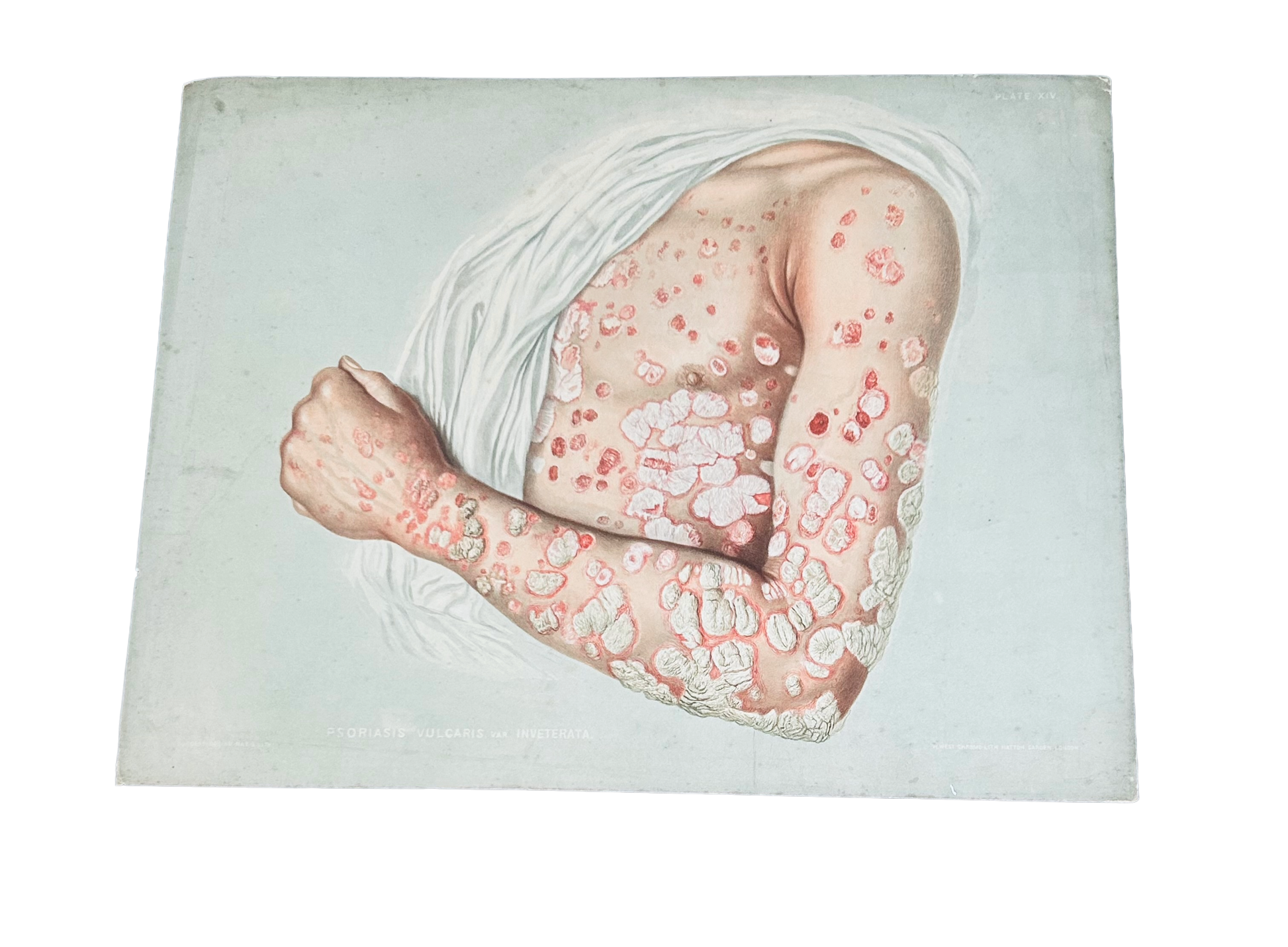 Victorian Medical Chromolithograph –  E. Burgess Diseases of the Skin  - Psoriasis Vulcaris (c.1870s) Plate XIV