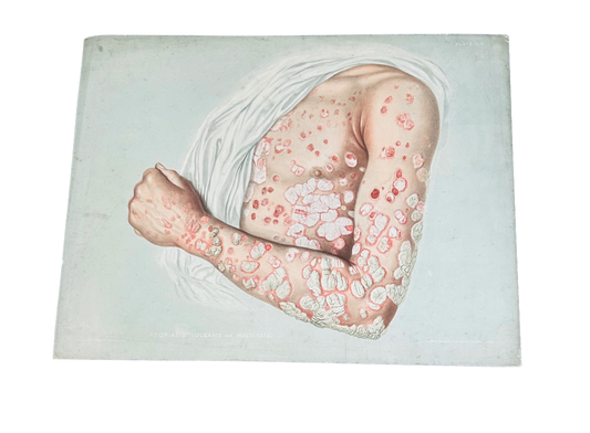 Victorian Medical Chromolithograph –  E. Burgess Diseases of the Skin  - Psoriasis Vulcaris (c.1870s) Plate XIV