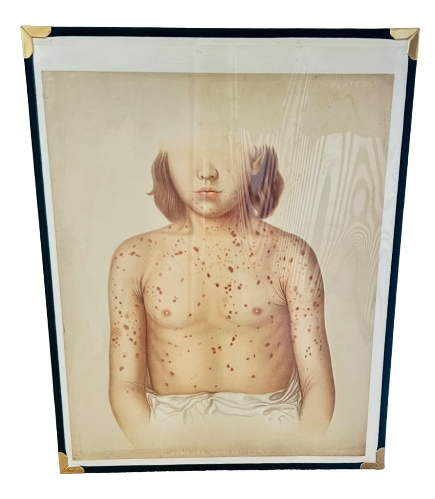 Victorian Medical Chromolithograph –  E. Burgess Diseases of the Skin  - (c.1870s) - Purpura Plate XLV