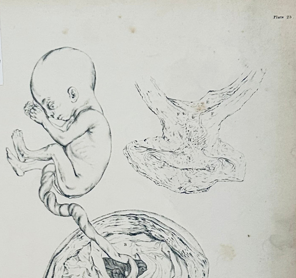 William Hunter Original Anatomical Engraving – Gravid Uterus - Tab XXV 1851