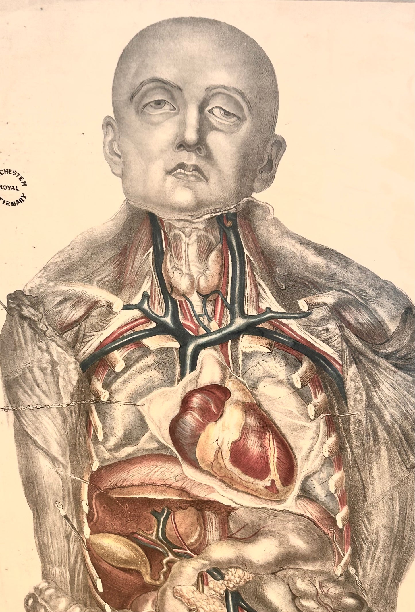 Sibson Anatomical Study Print – Human Torso & Organs, Manchester Royal Infirmary Dissection Plate IV 19th c.