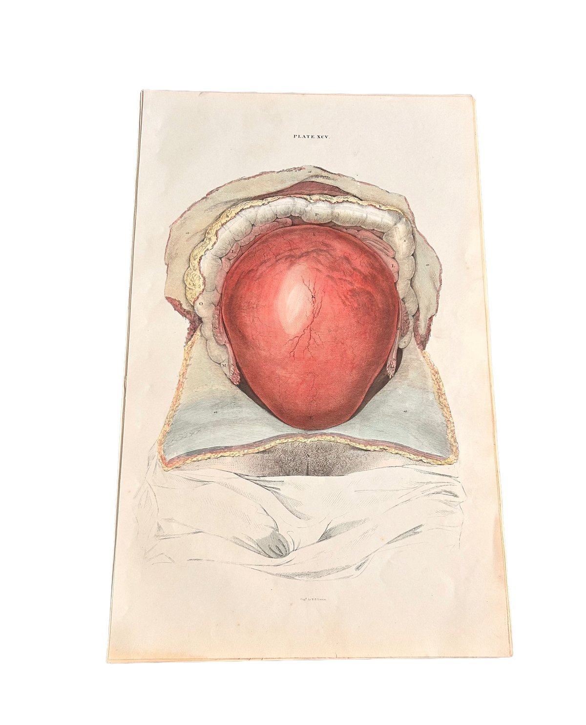 Antique Lizars Anatomical Engraving, Womb Dissection, Plate XCV, c. 1823–1827