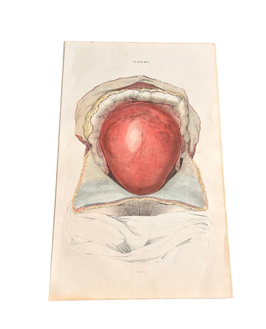 Antique Lizars Anatomical Engraving, Womb Dissection, Plate XCV, c. 1823–1827