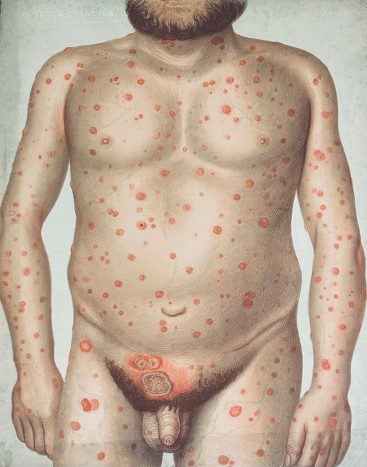 This plate documents an indurated chancre (primary syphilis), recorded in Victorian dermatological practice - antique coloured medical illustration
