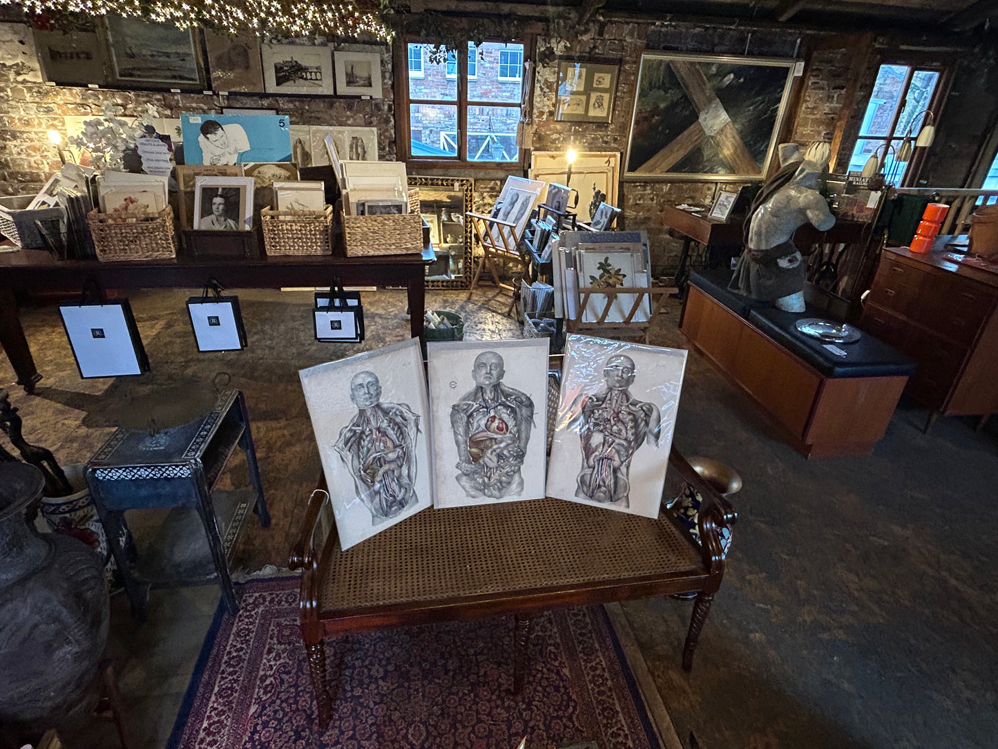 19th‑Century Human Anatomy Print – Sibson Plate II Post‑Mortem Study (Dark Academia Wall Art)