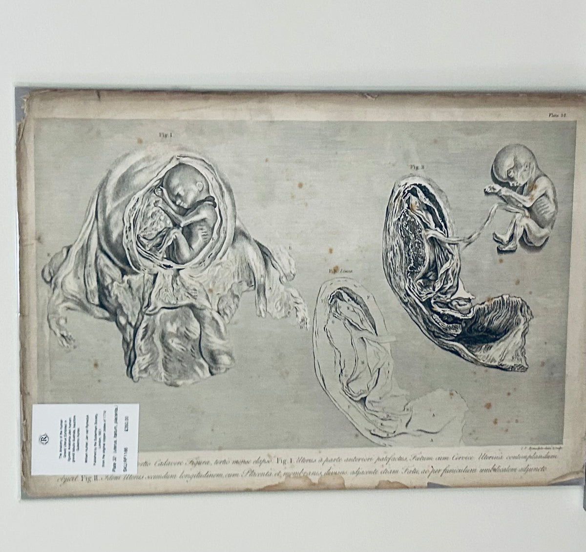 Human Gravid Uterus - William Hunter Anatomical Drawing Gravid Uterus, Placenta, Foetus Tab  Plate 32