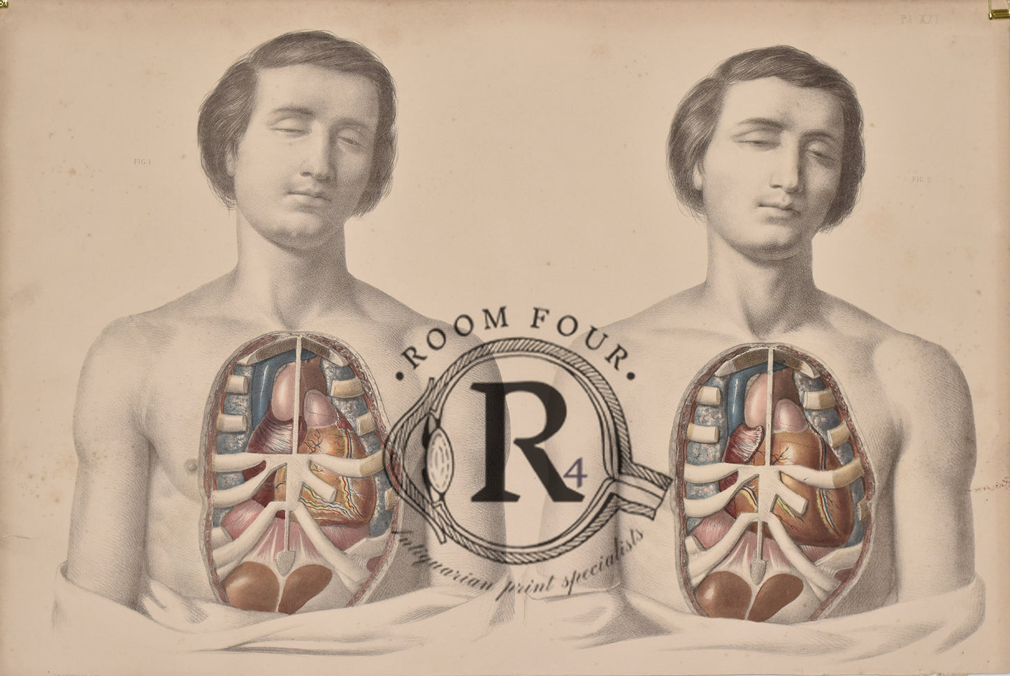 Human Anatomy Surgical Post Mortem Drawings 19th Century - Twins