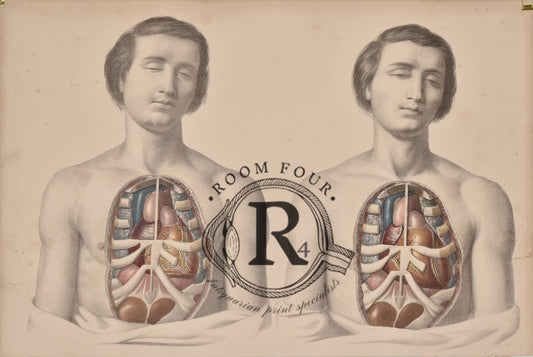 Human Anatomy Surgical Post Mortem Drawings 19th Century - Twins