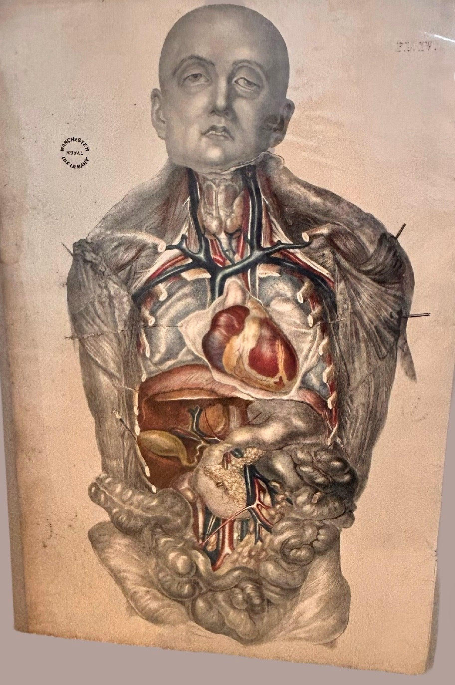 Sibson Anatomical Study Print – Human Torso & Organs, Manchester Royal Infirmary Dissection Plate IV 19th c.