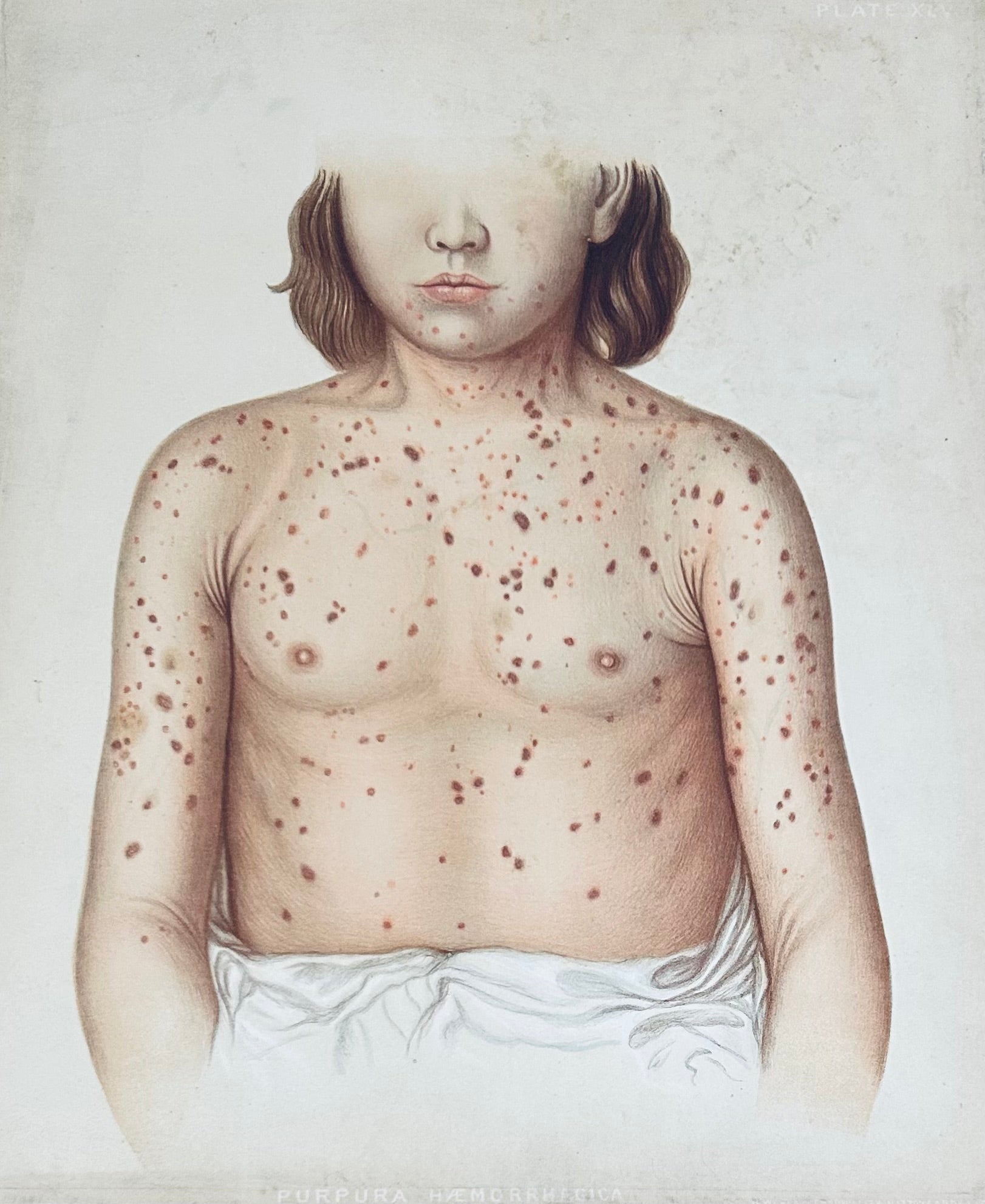 Victorian Medical Chromolithograph –  E. Burgess Diseases of the Skin  - (c.1870s) - Purpuru Plate XLV