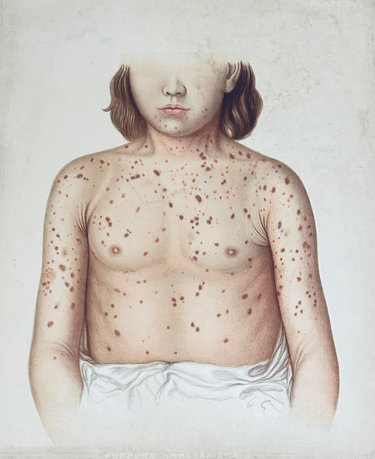 Victorian Medical Chromolithograph –  E. Burgess Diseases of the Skin  - (c.1870s) - Purpuru Plate XLV