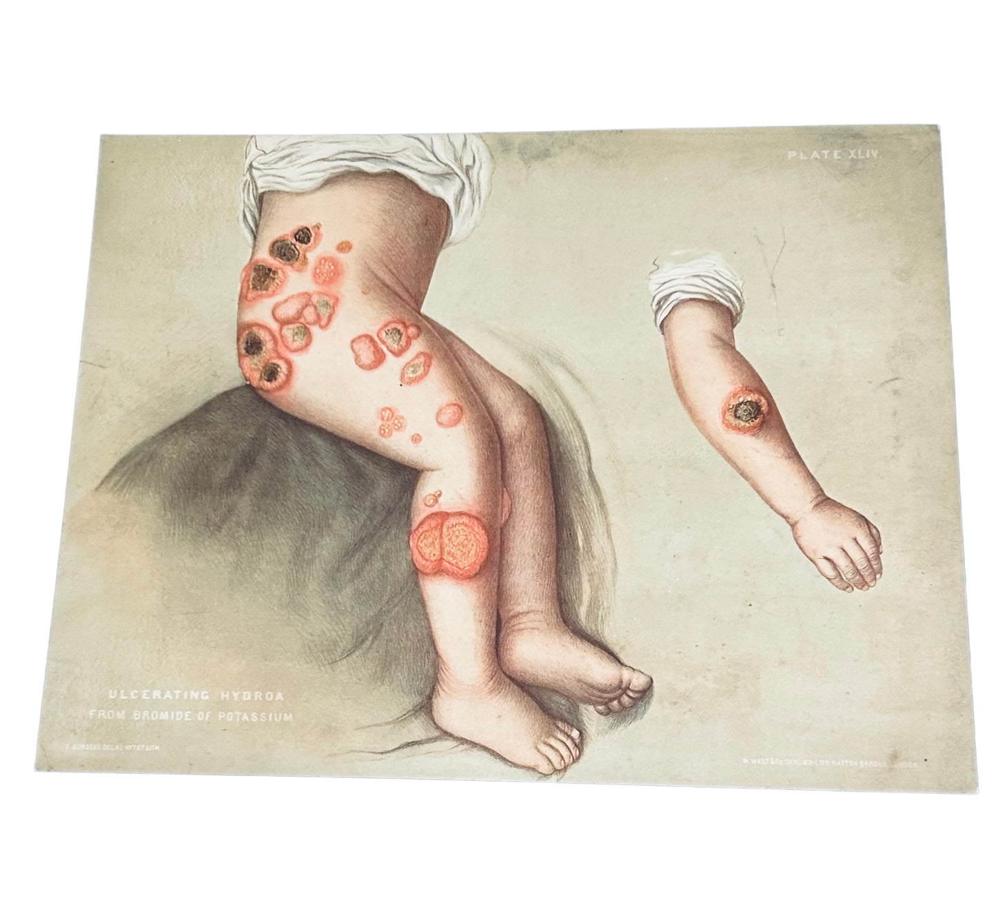 Victorian Medical Chromolithograph – E. Burgess Diseases of the Skin - Ulcerating Hydroa – (c.1870s) 