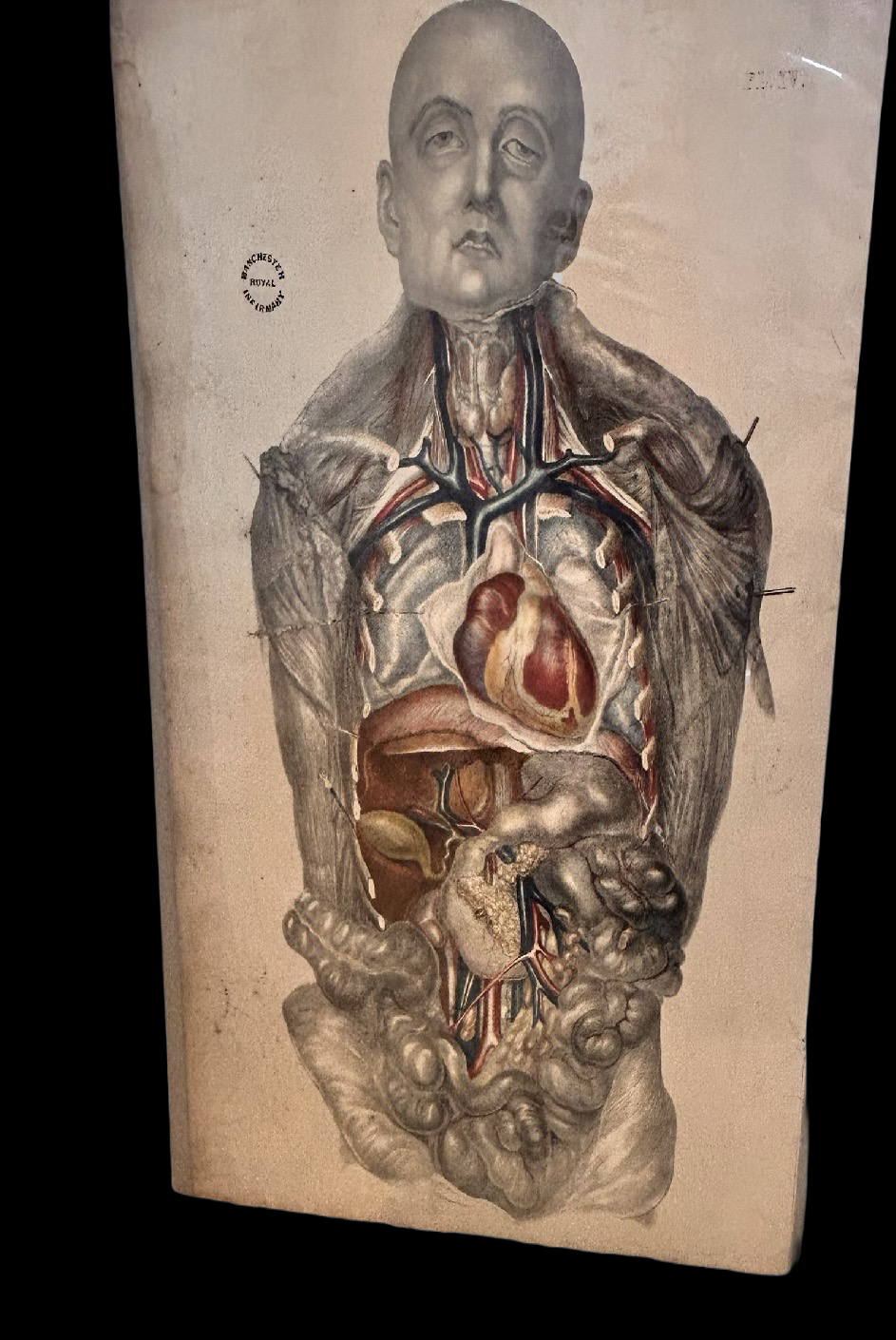 Sibson Anatomical Study Print – Human Torso & Organs, Manchester Royal Infirmary Dissection Plate IV 19th c.