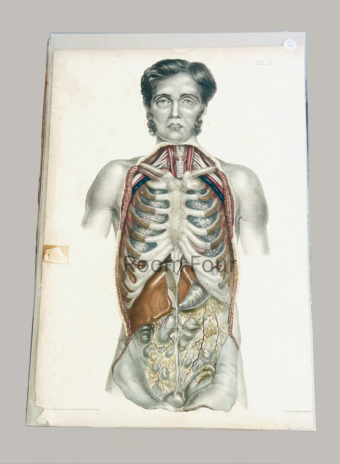 Sibson Anatomical Drawing – Original 19th‑Century Surgical Dissection Illustration