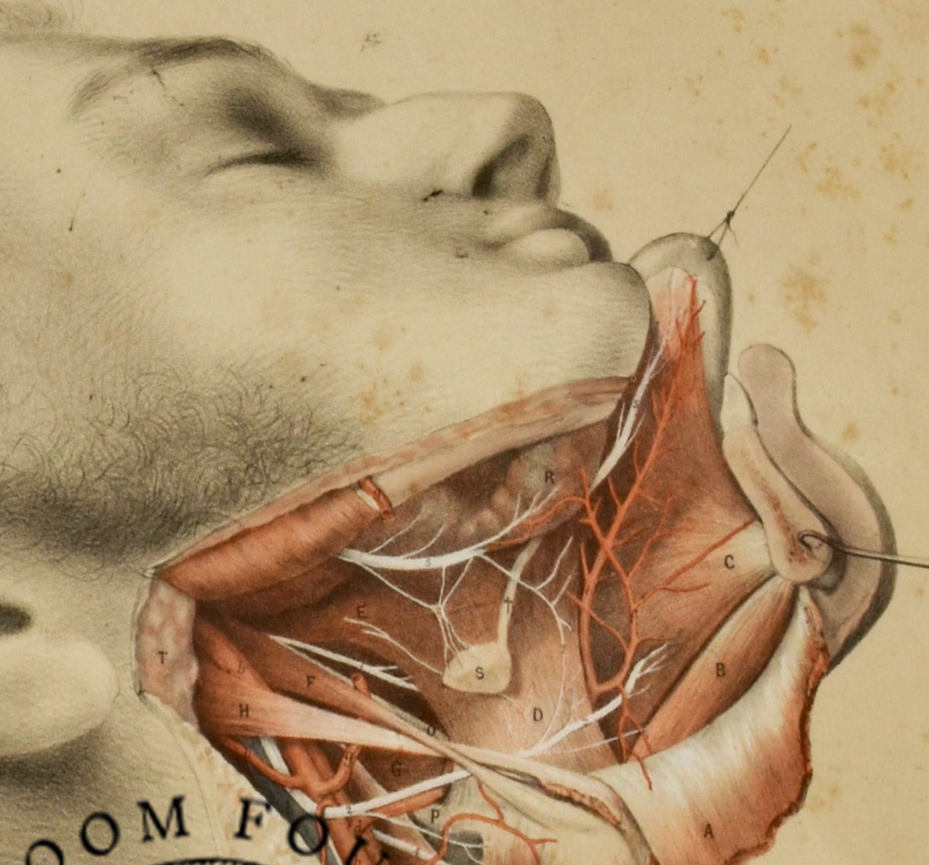 Anatomical Post‑Mortem Illustration — Submaxillary Region Dissection | Ford, 19th‑Century Original