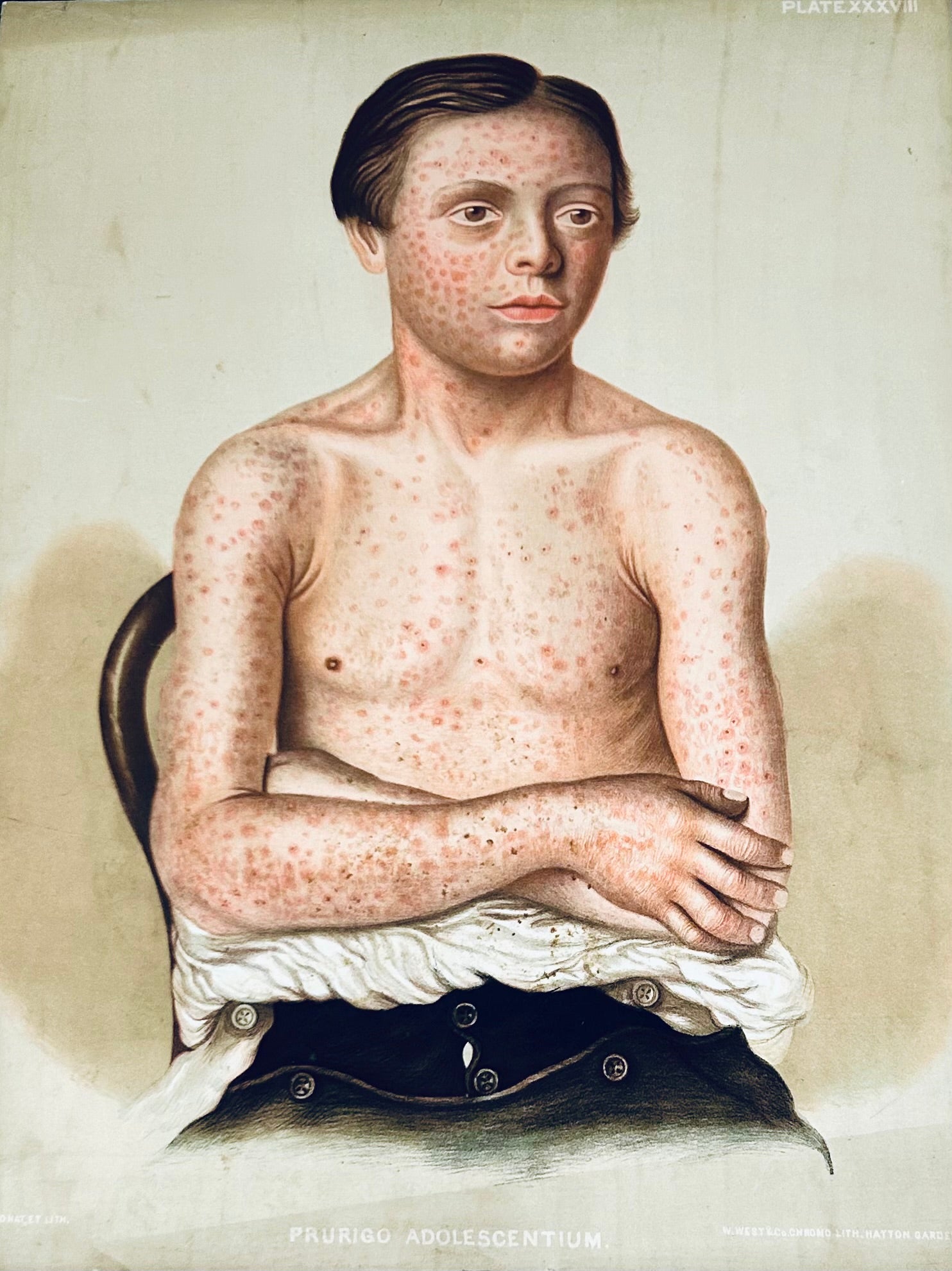 Victorian Medical Chromolithograph – Prurigo Adolescentium Plate XXXVIII – E. Burgess Dermatology Print (c.1870s) - picture of a boy with upper body exposed and virus evident.
