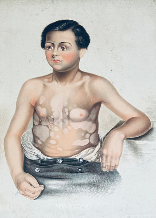 Victorian Skin Disease - Victorian Medical Chromolithograph  – E. Burgess Dermatology Print (c.1870s) Leucoderma