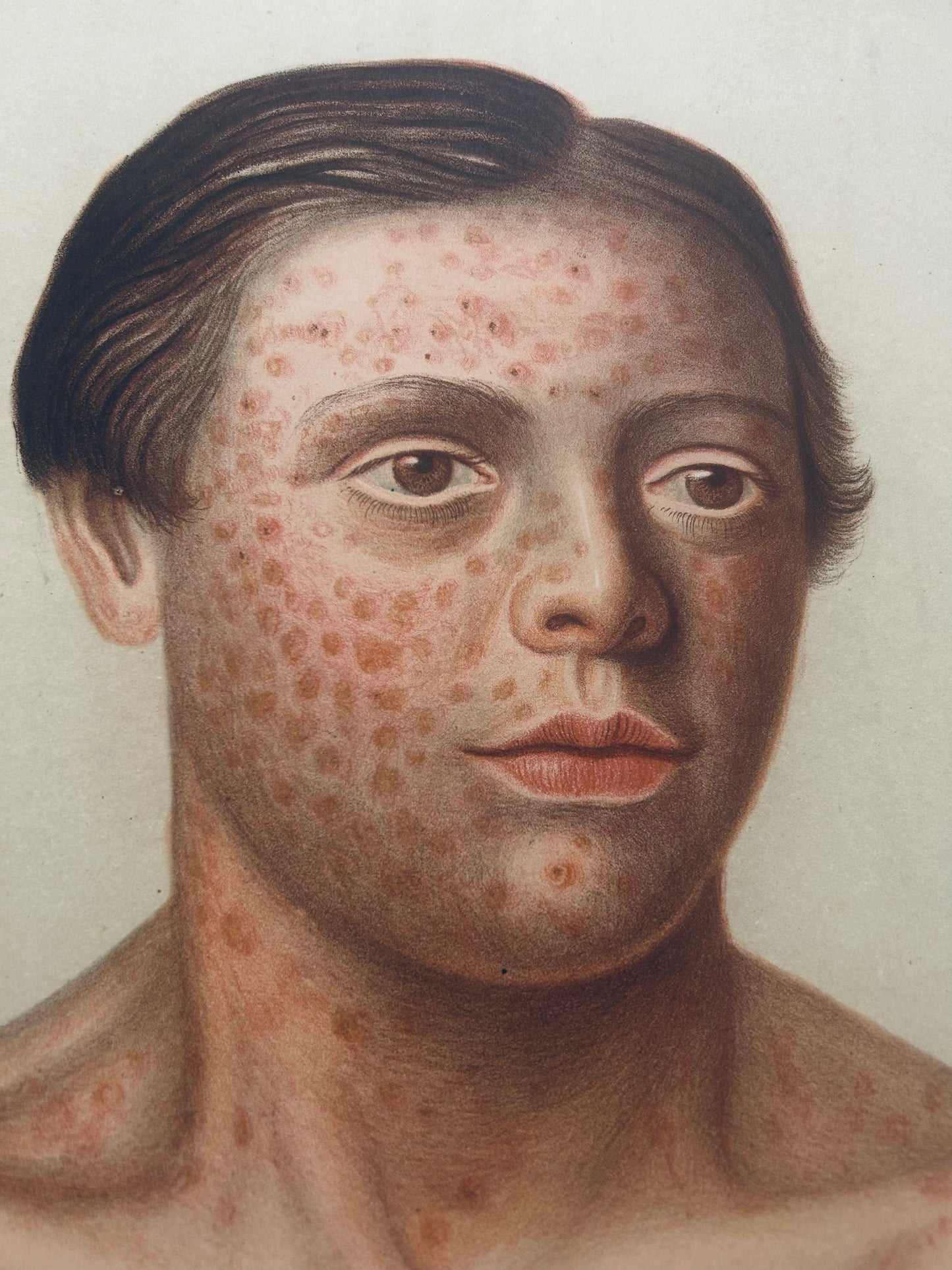 Victorian Medical Chromolithograph – E. Burgess Diseases of the Skin - Prurigo Adolescentium – Plate XXXVIII  (c.1870s)