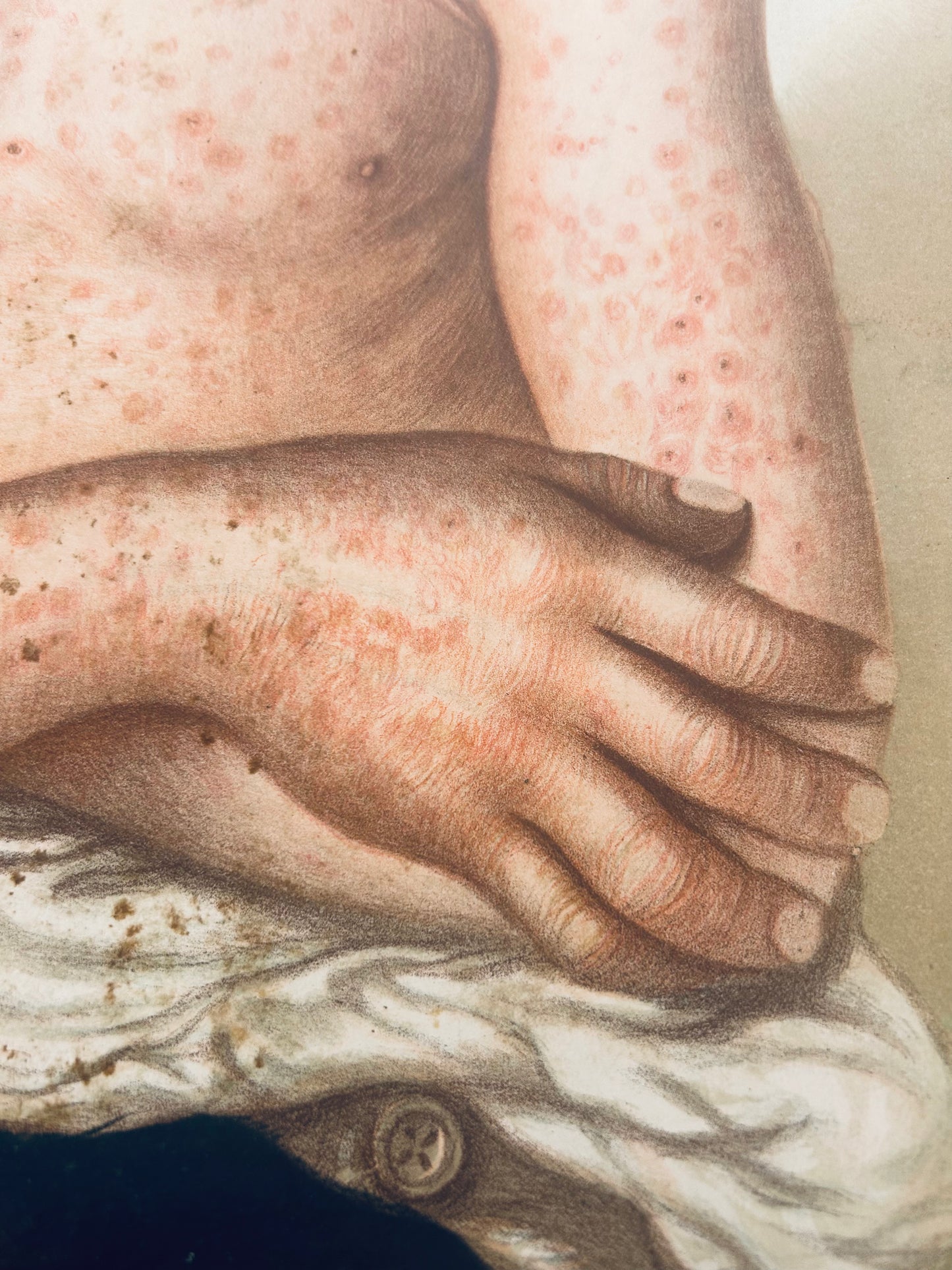 Victorian Medical Chromolithograph – E. Burgess Diseases of the Skin - Prurigo Adolescentium – Plate XXXVIII  (c.1870s)