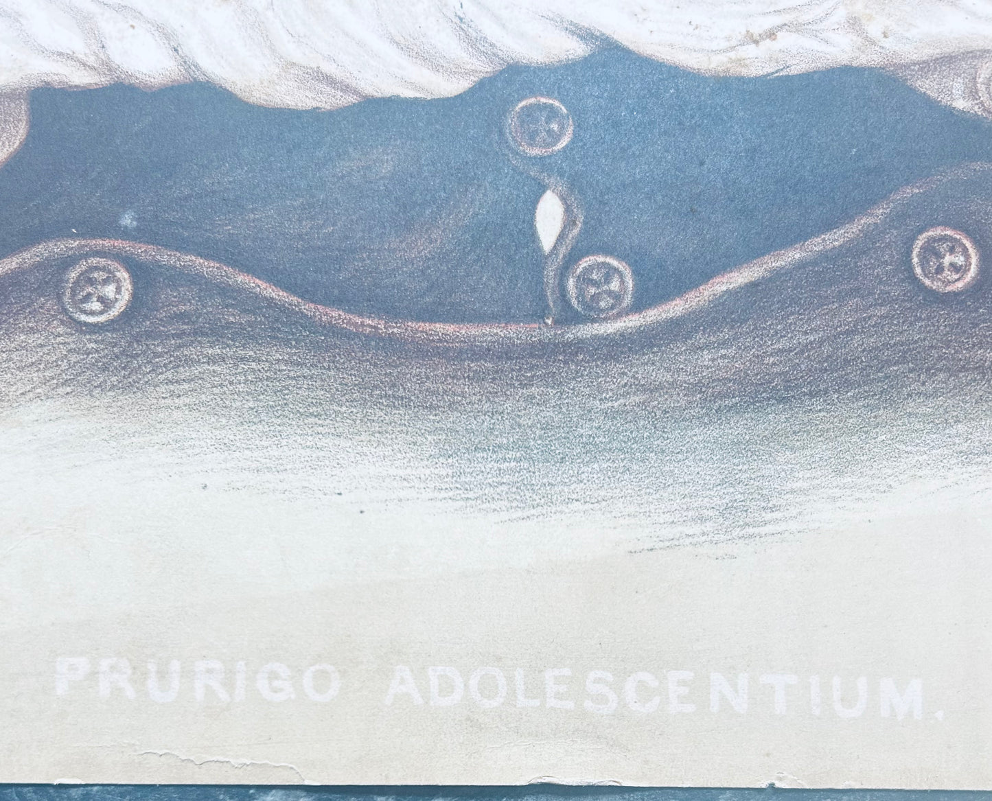 Victorian Medical Chromolithograph – E. Burgess Diseases of the Skin - Prurigo Adolescentium – Plate XXXVIII  (c.1870s)