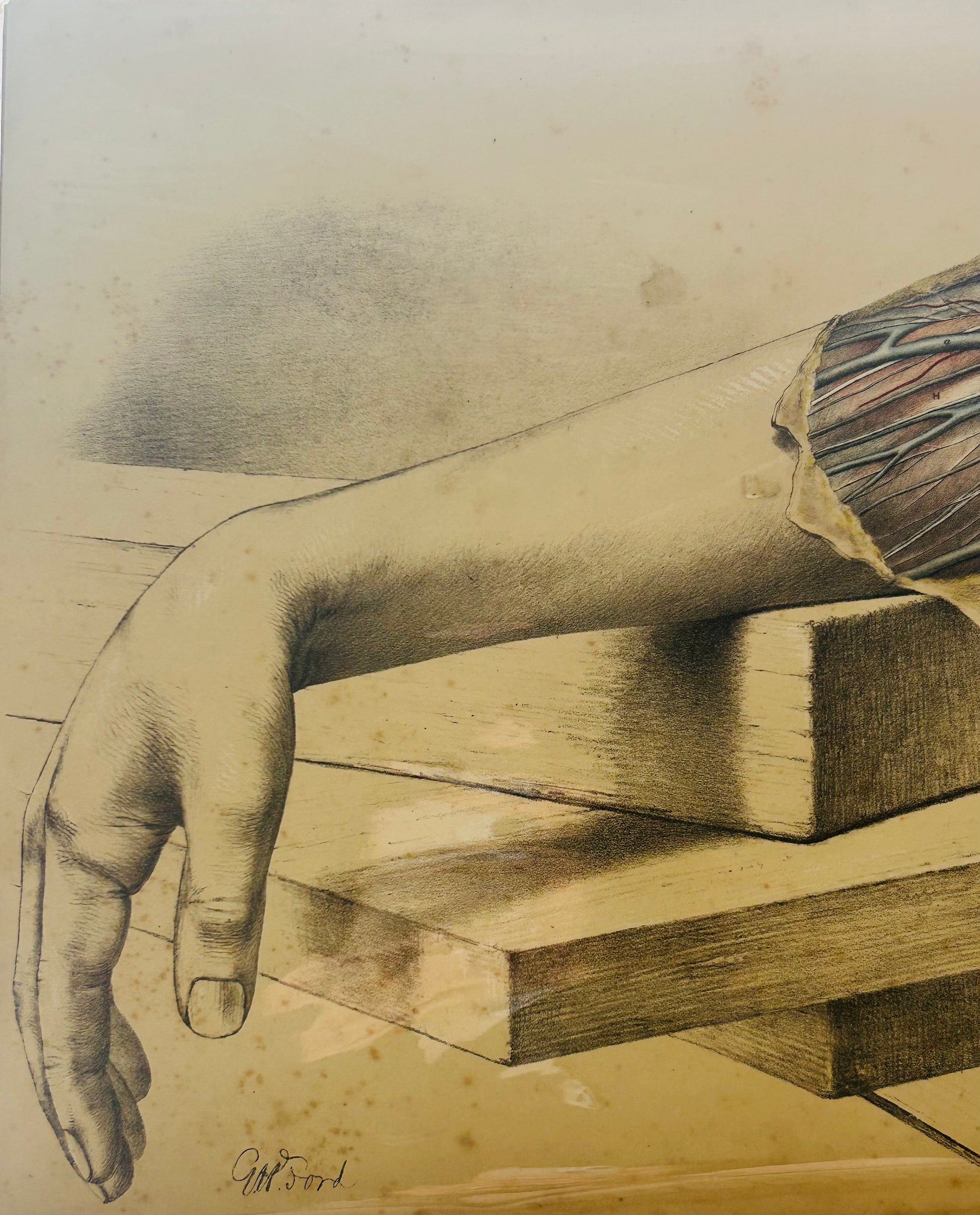 Antique Print Original - Medical Arm Dissection Vascular 