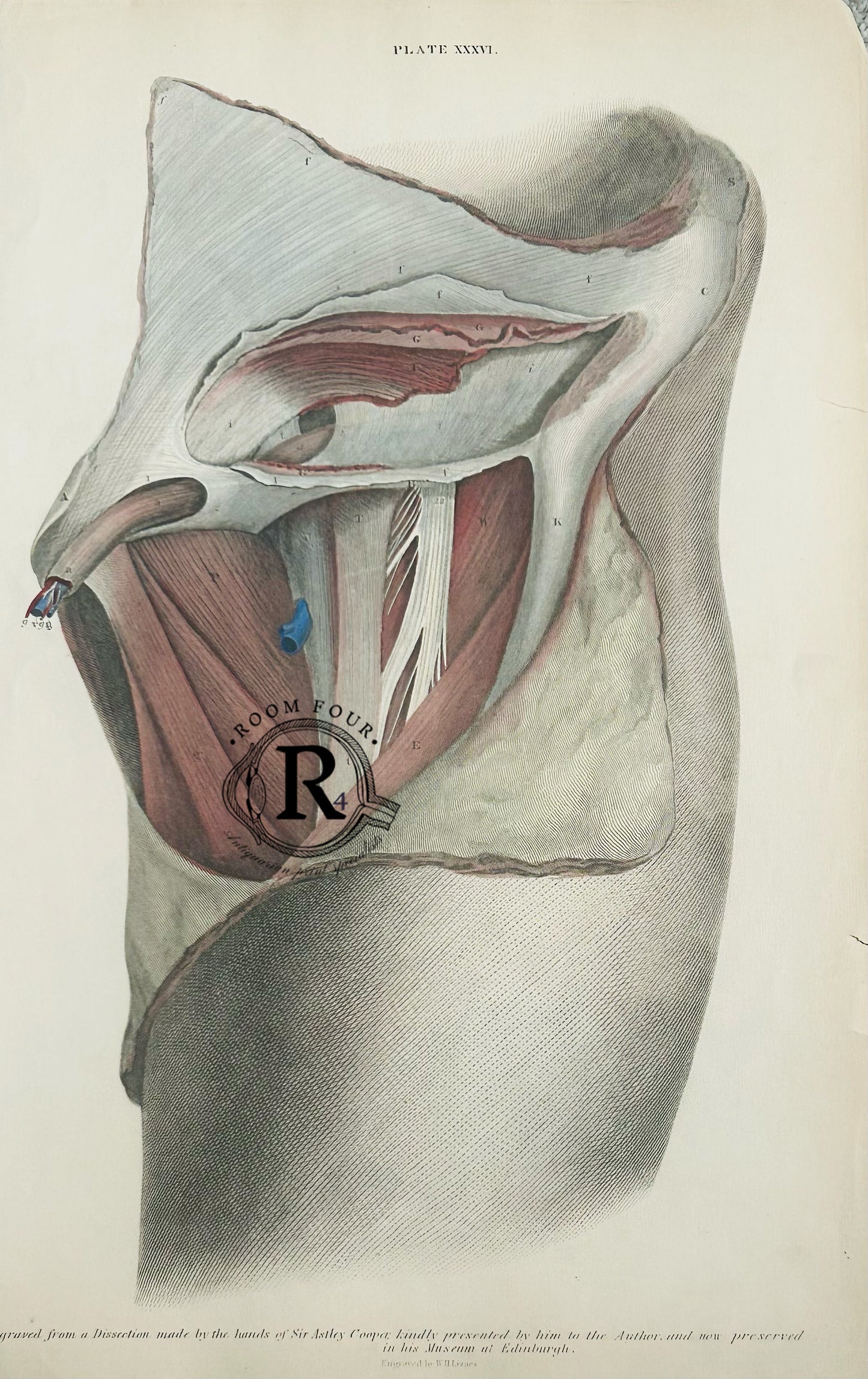 Lizars Anatomical Drawing Dissections of Inguinal & Crural Hernia (c.1823) Plate XXXVI | Antique Anatomical Engraving by John Lizars