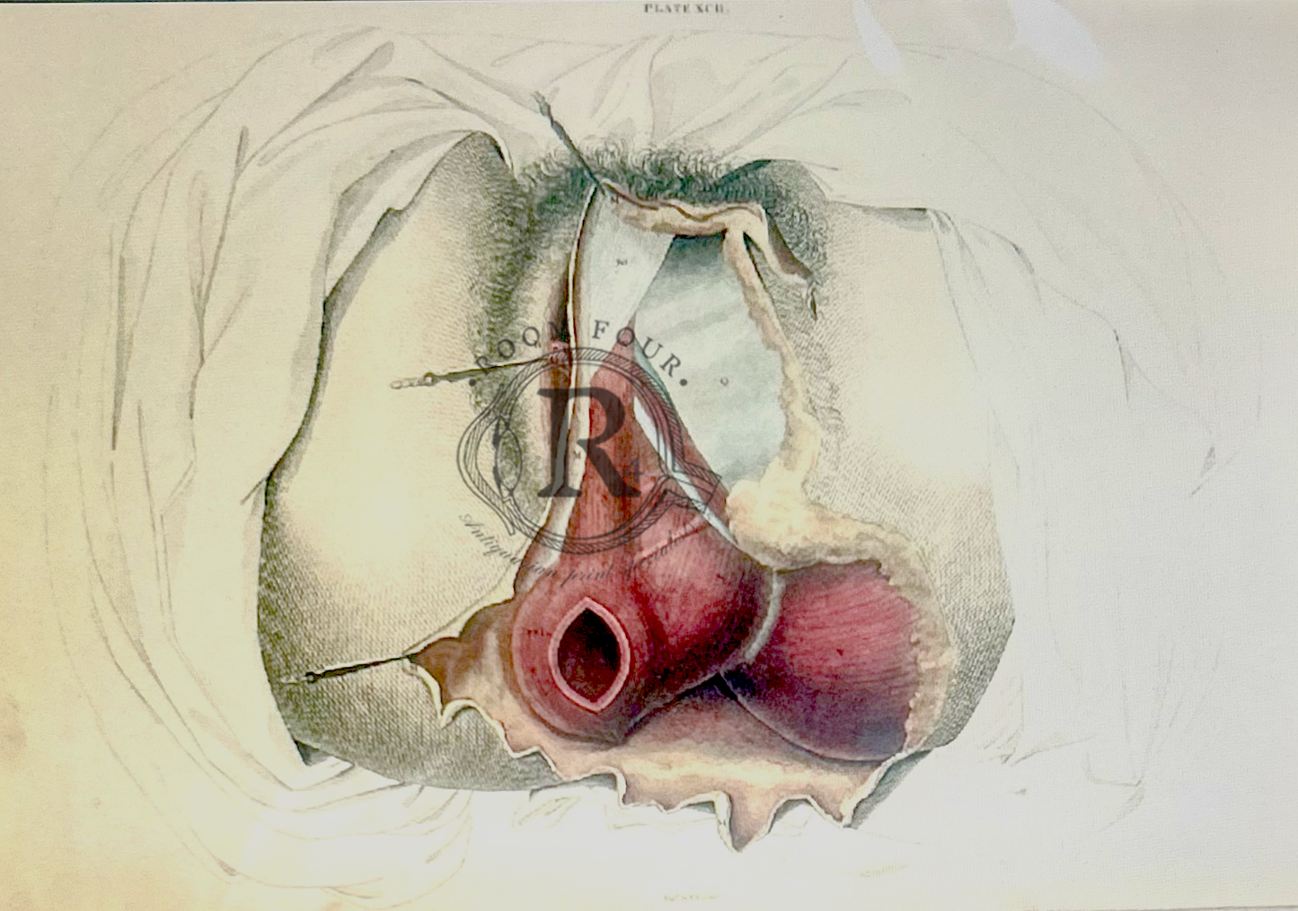 John Lizars Female Anatomy Drawing – Plate XCII, 19th Century Original Medical Illustration - female anatomy