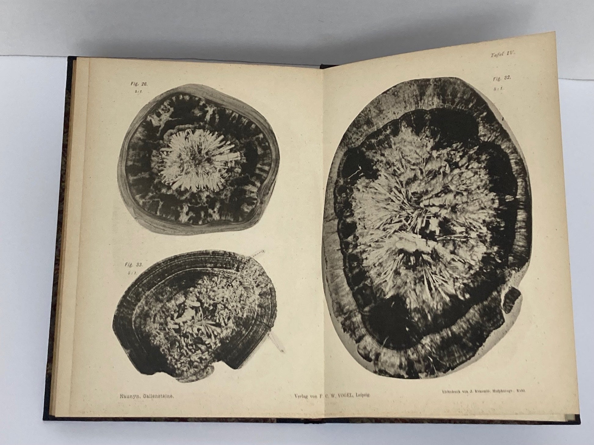 Klinik der Cholelithiasis, First Edition, 1892,(Gall Stones) - Room Four
