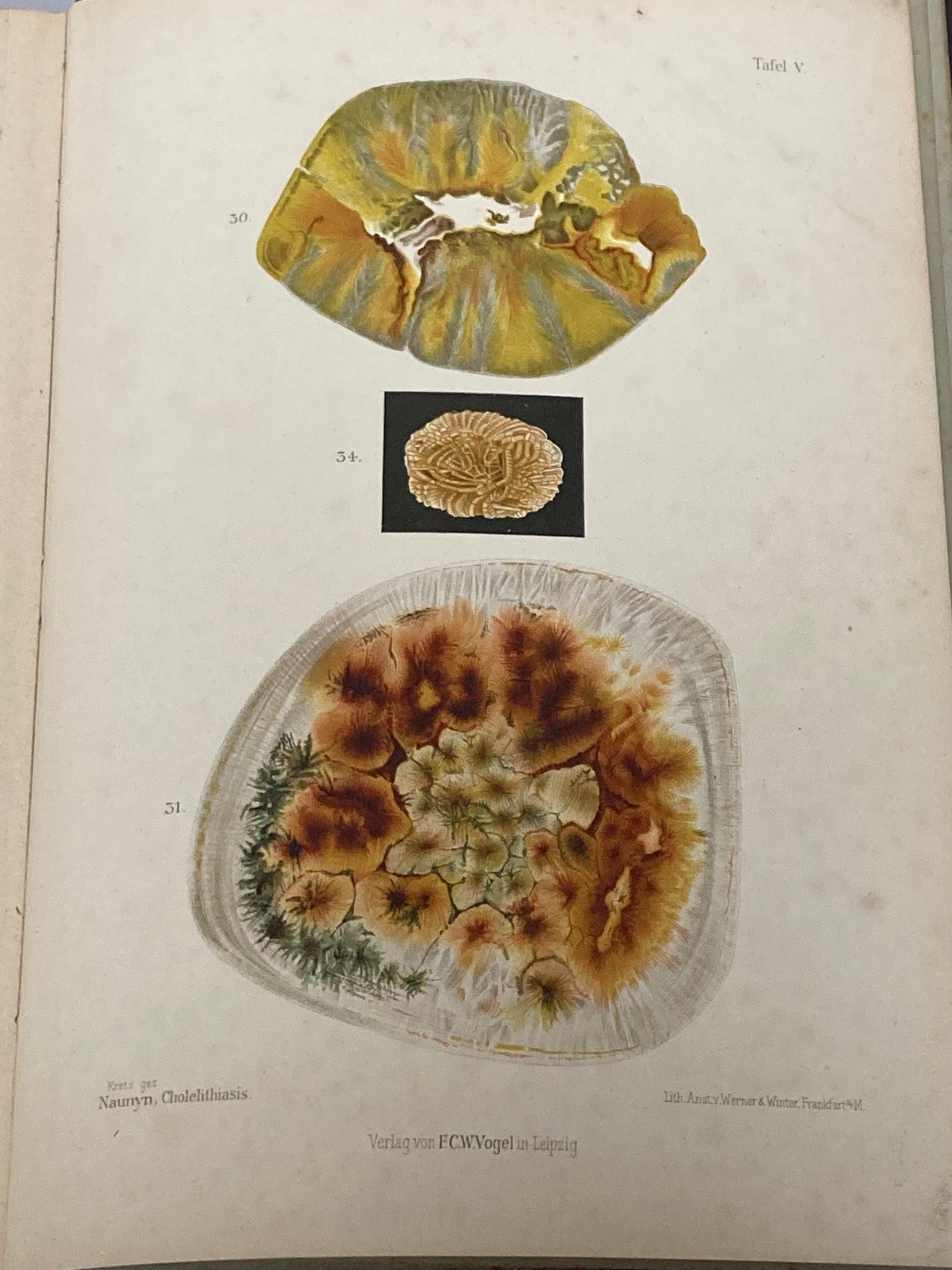 Klinik der Cholelithiasis, First Edition, 1892,(Gall Stones) - Room Four