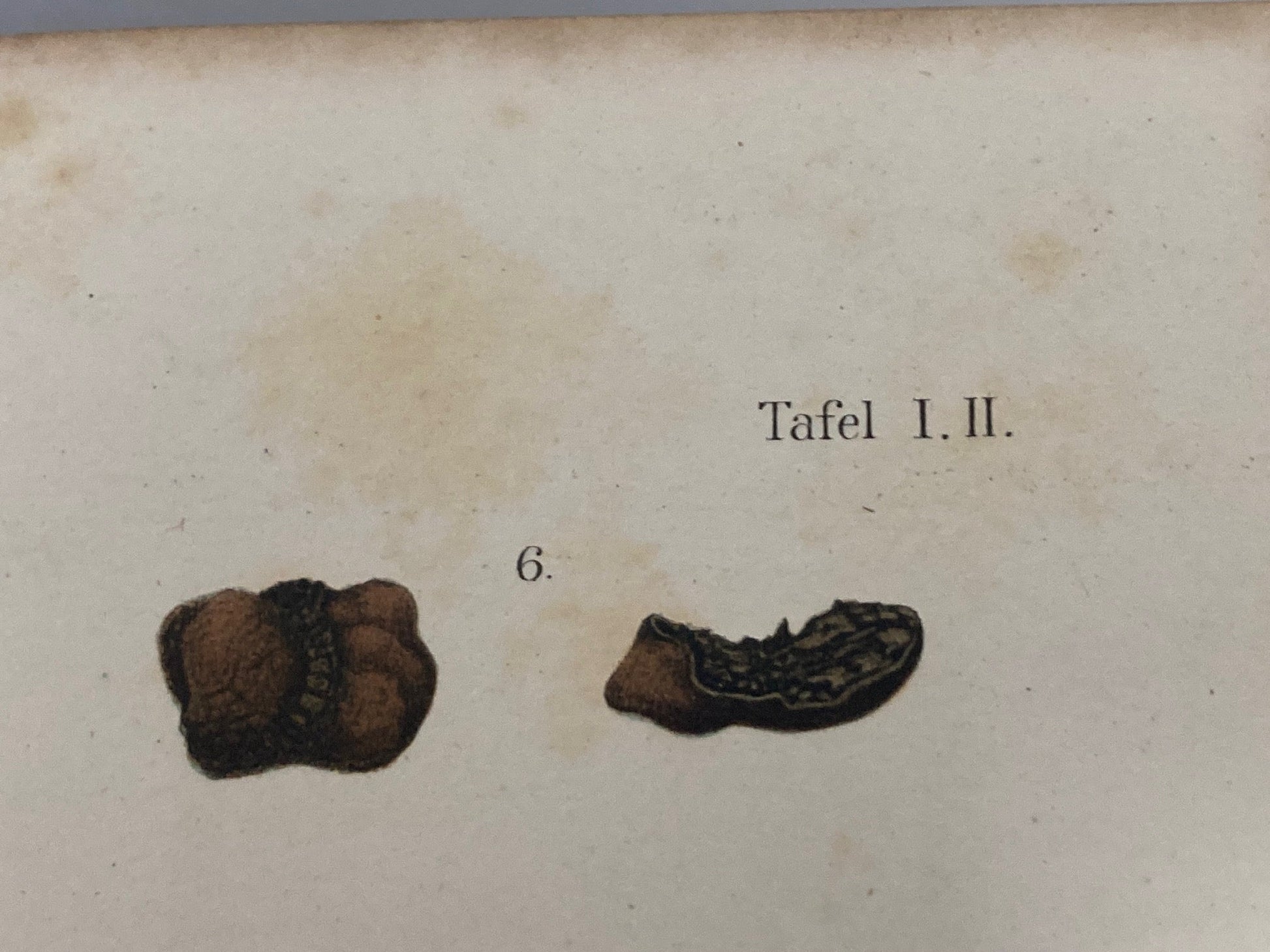 Klinik der Cholelithiasis, First Edition, 1892,(Gall Stones) - Room Four