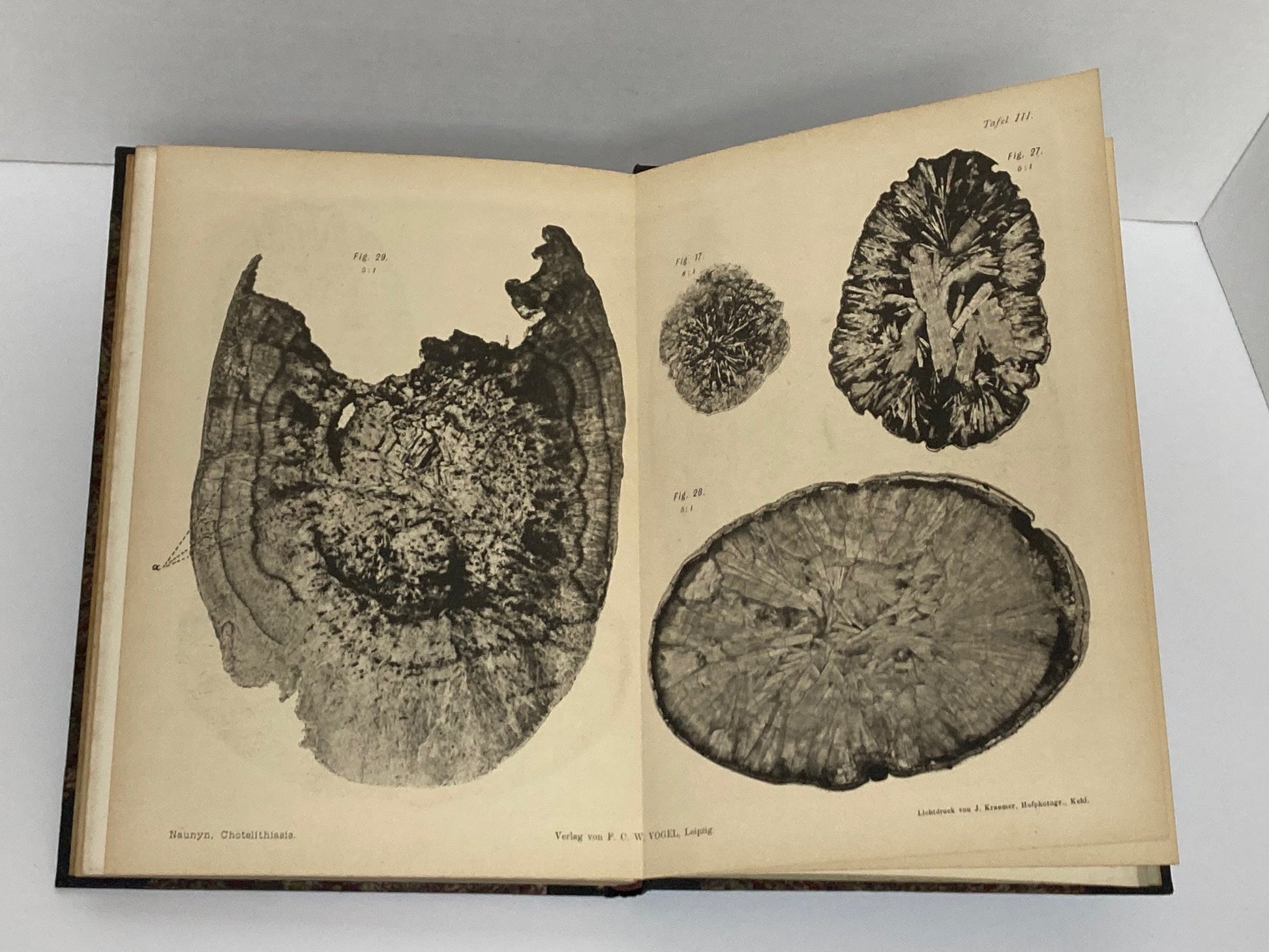 Klinik der Cholelithiasis, First Edition, 1892,(Gall Stones) - Room Four
