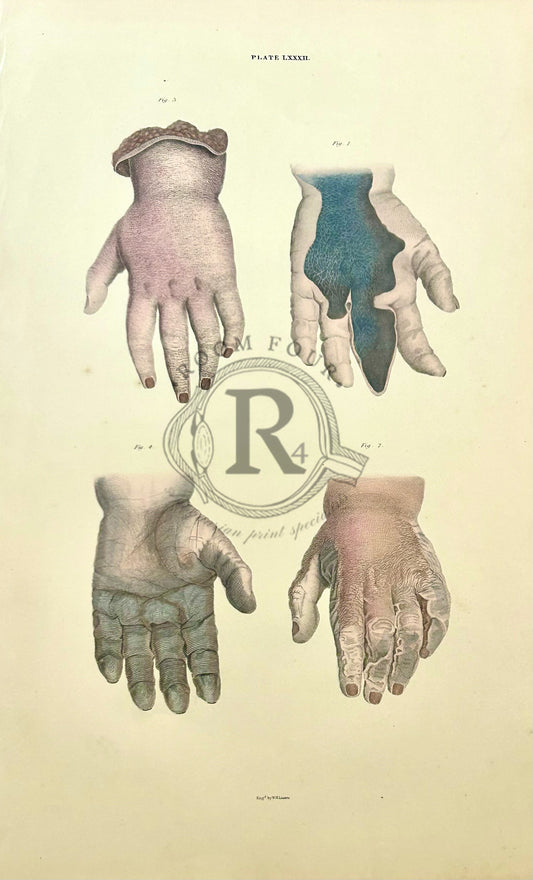 John Lizars Original 19th Century Anatomical Engraving – Plate LXXXII– Hands