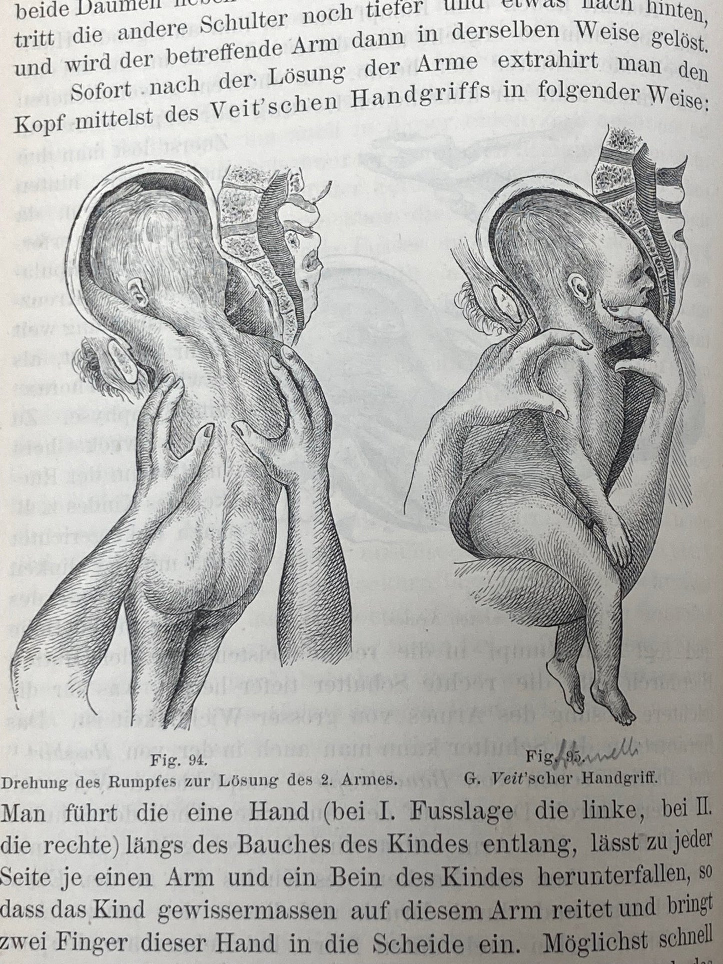 (Obstetrics) Lehrbuch der Geburtshilfe - 1891 - Room Four