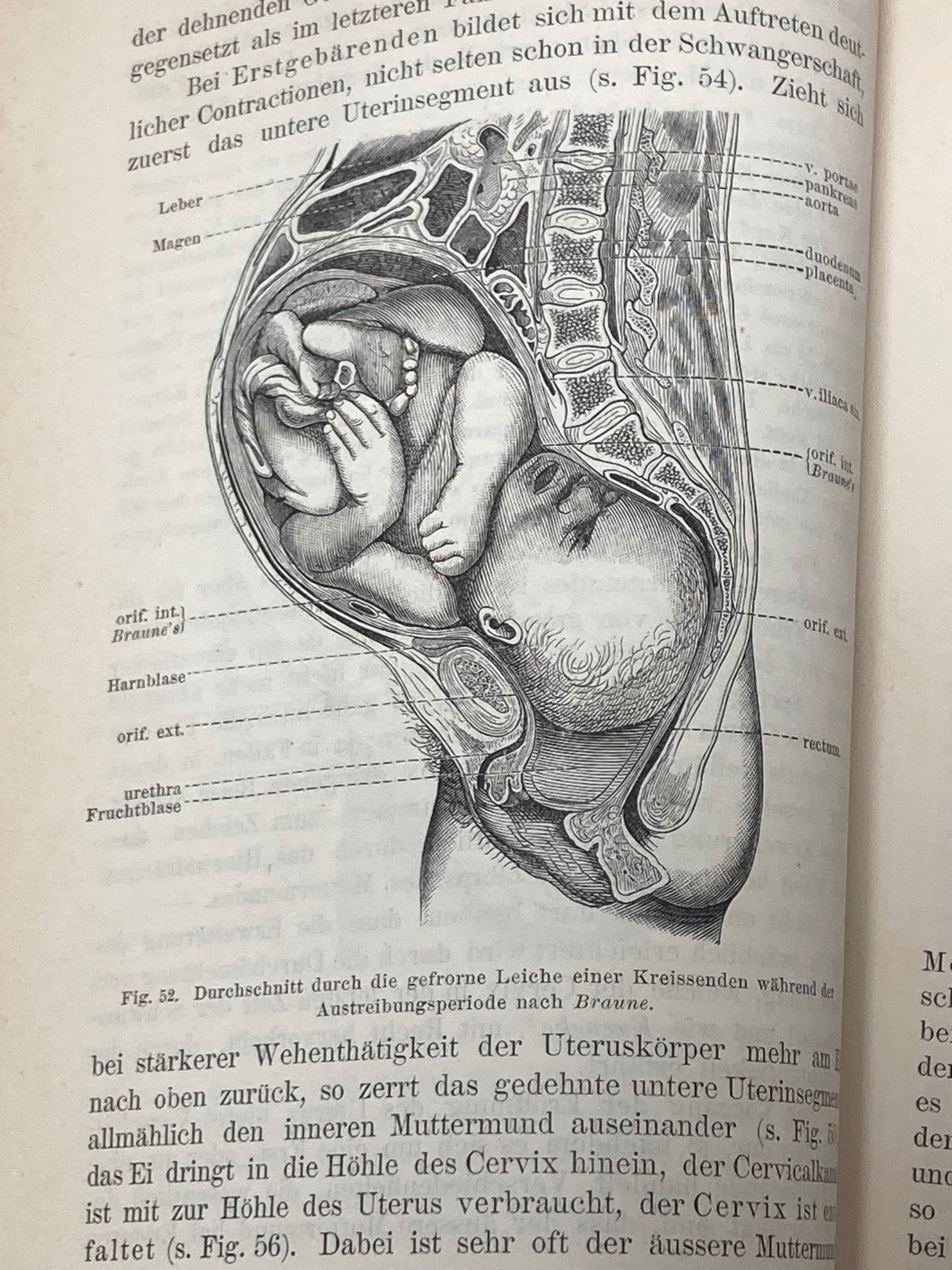(Obstetrics) Lehrbuch der Geburtshilfe - 1891 - Room Four