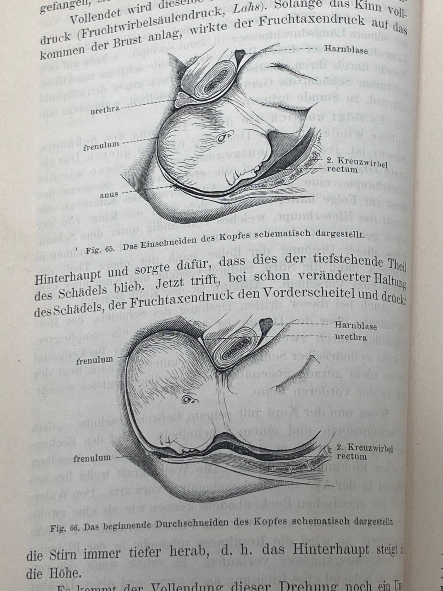 (Obstetrics) Lehrbuch der Geburtshilfe - 1891 - Room Four