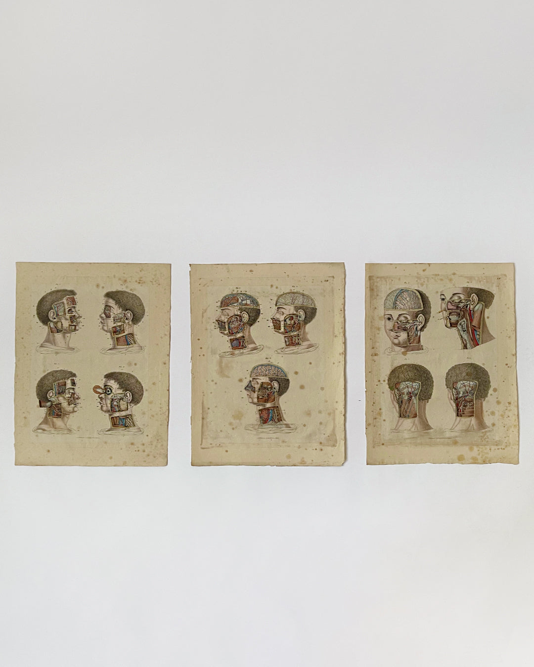 An early and rare set of three hand coloured engravings illustrating pioneering surgery of the head & neck. Used as a teaching aid for medical students, continental in origin and published circa 1824 - 1830 the graphically detailed content exemplifies close collaboration between Surgeon & Artist (often the same person) and drawn post mortem. Colours remain strong with light foxing and toning throughout. (3)