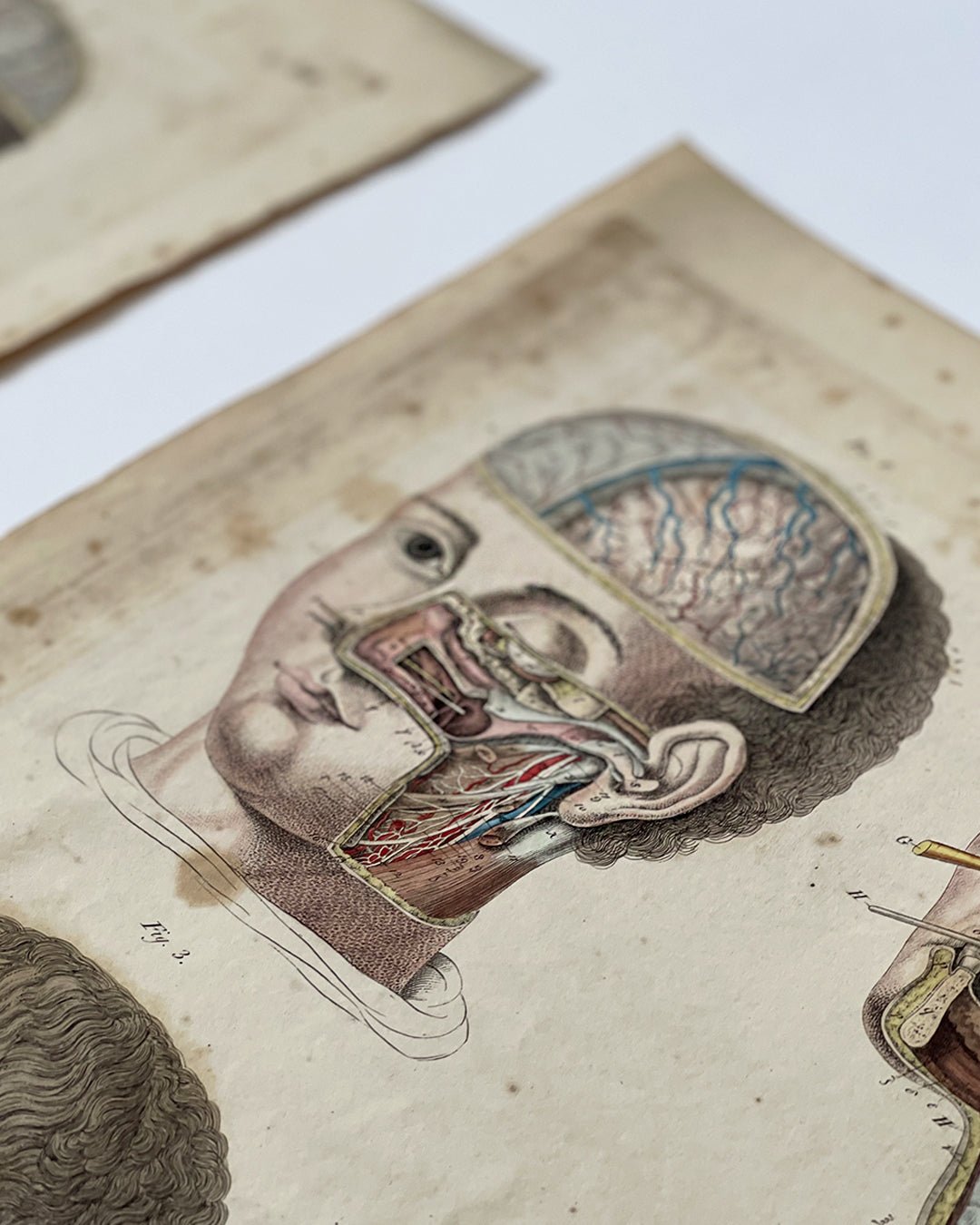 Early Anatomy Coloured Engravings Wall Art Post Mortem - Head - Room Four