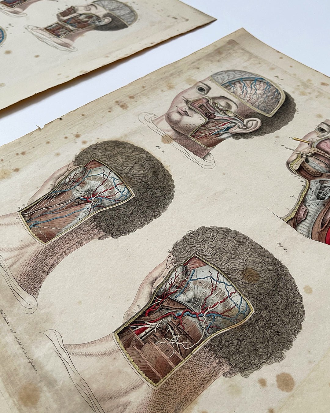 Early Anatomy Coloured Engravings Wall Art Post Mortem - Head - Room Four