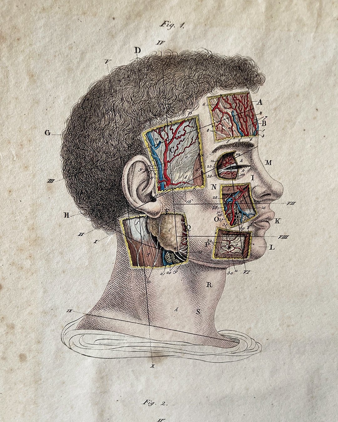 Early Anatomy Coloured Engravings Wall Art Post Mortem - Head - Room Four